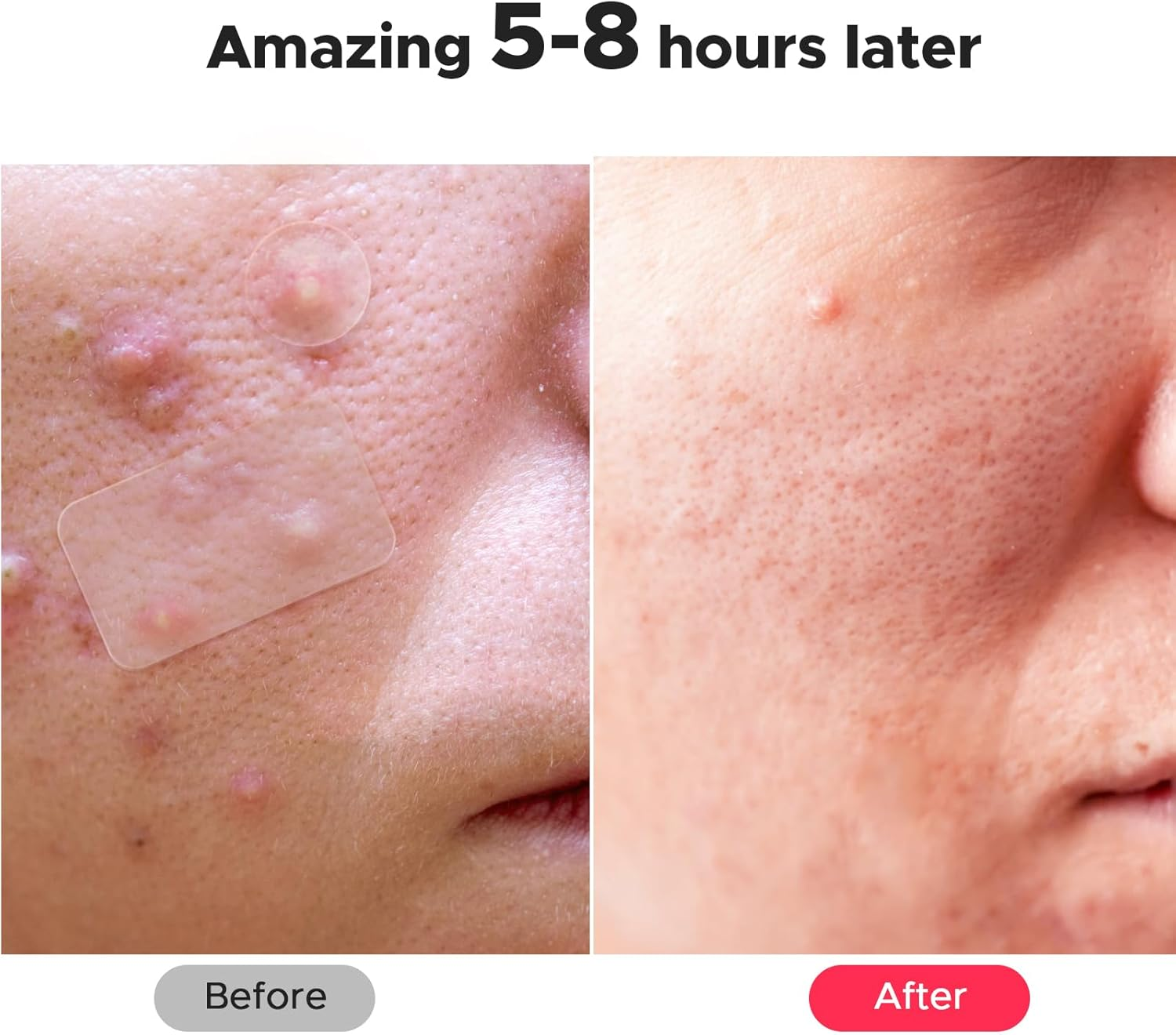 Litbear Large Pimple Patches, 5 Sizes 156 Patches Big Acne Patch, 60 XL Hydrocolloid Patch for Full Face, Forehead, Chin, Nose, Body, Back, Neck & Chest, Stirp, Square Large Hydrocolloid Bandages image number 2