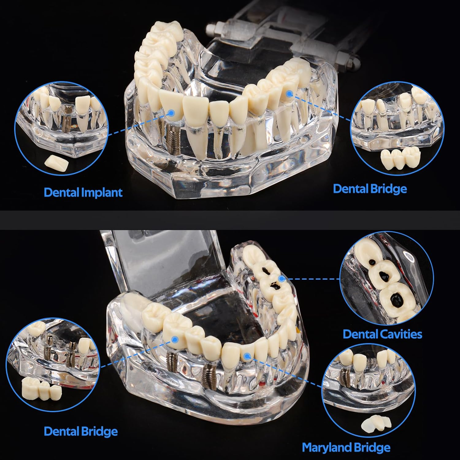 Ultrassist Transparent Disease Teeth Model