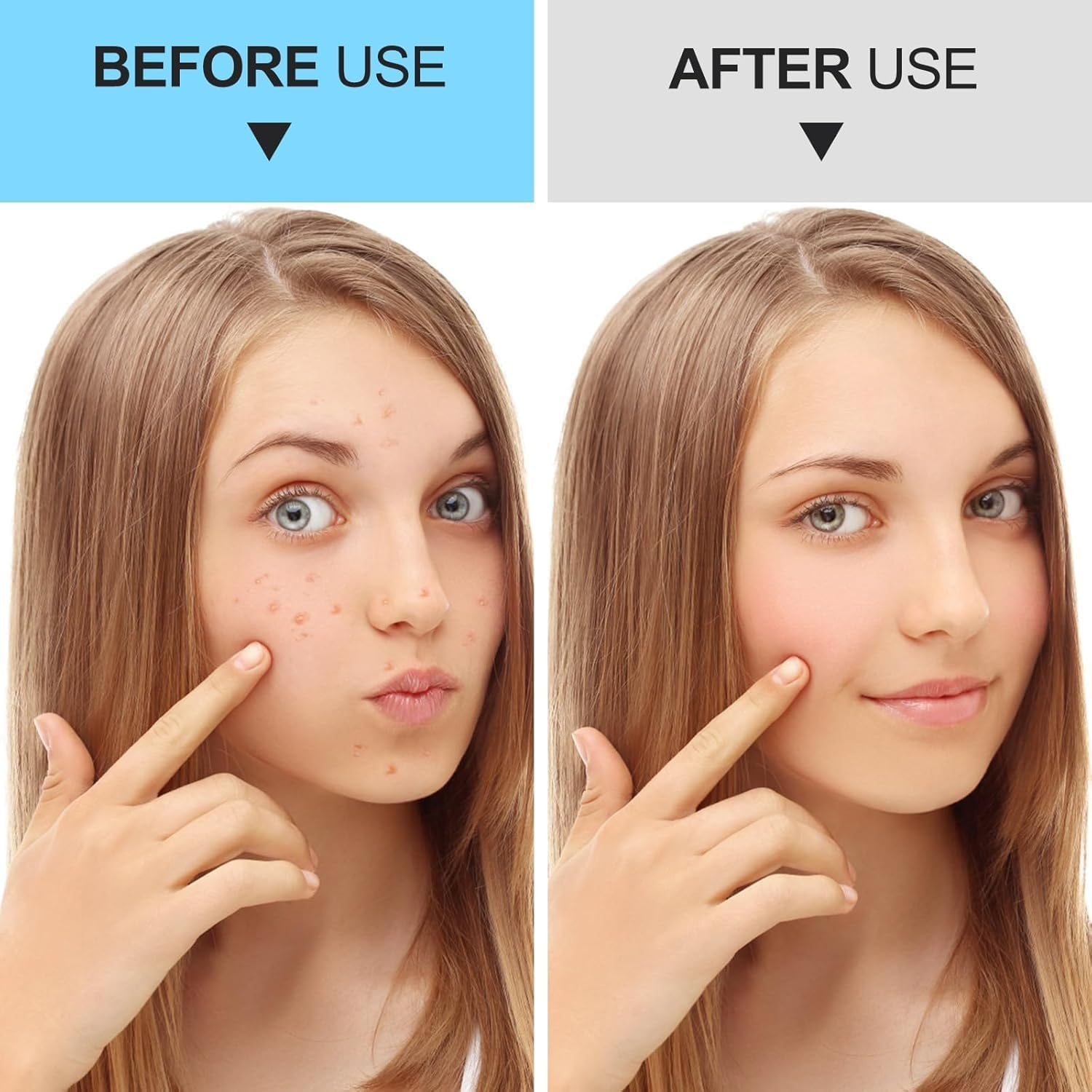 5 PCS Pimple Popper Tool Kit Blackhead Remover Tools, Acne Tools, Black Head Remover for Face, Risk Free Treatment Pimple Extractor with Tweezers,Premium Stainless Steel image number 4