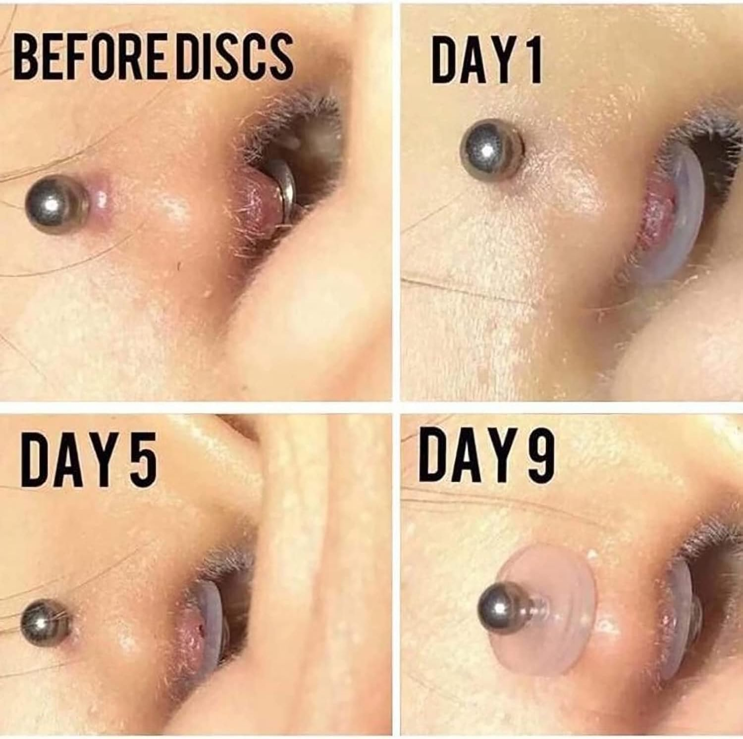 Clear Piercing Disc for Piercing Bump,Pressure Silicone Earrings for Keloids Healing Pads Belly Button Piercing Kit - Style15 - 5Mm 8Pcs image number 2