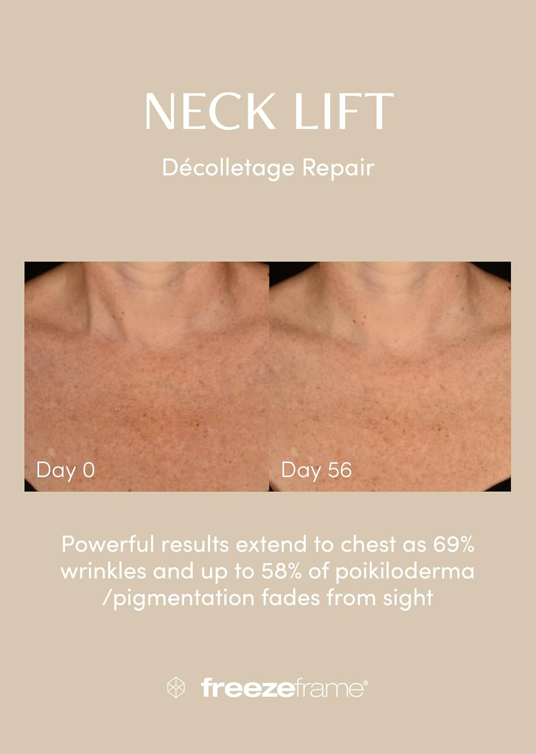 Freezeframe NECK LIFT image number 2