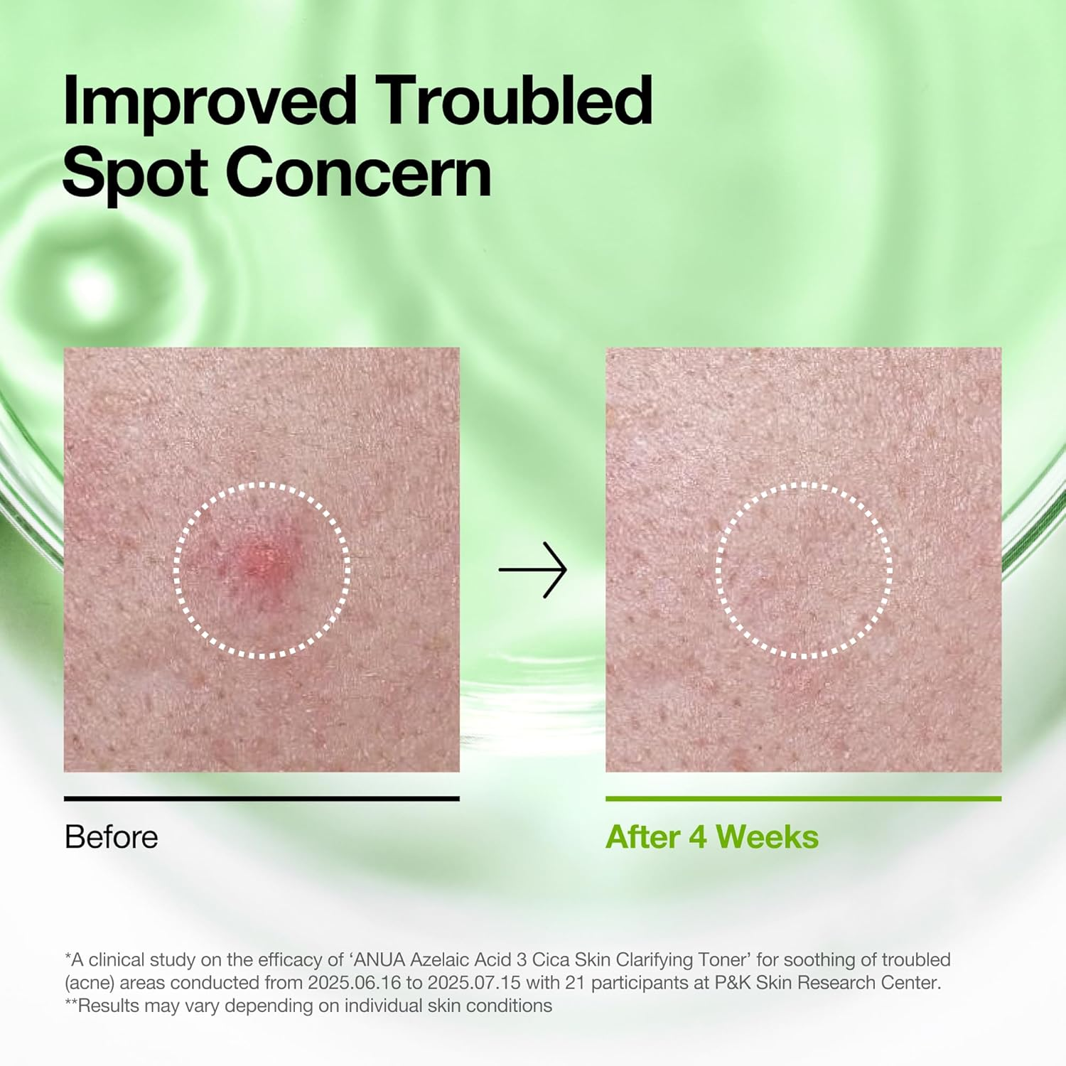 Anua Azelaic Acid 3 Cica Skin Claryfing Toner, Soothing & Clear Care, with Salicylic Acid & Azelaic Acid, Sebum & Spot Care, Suitable for Sensitive Skin, Korean Skin Care (250Ml / 8.45 Fl.Oz.) image number 4