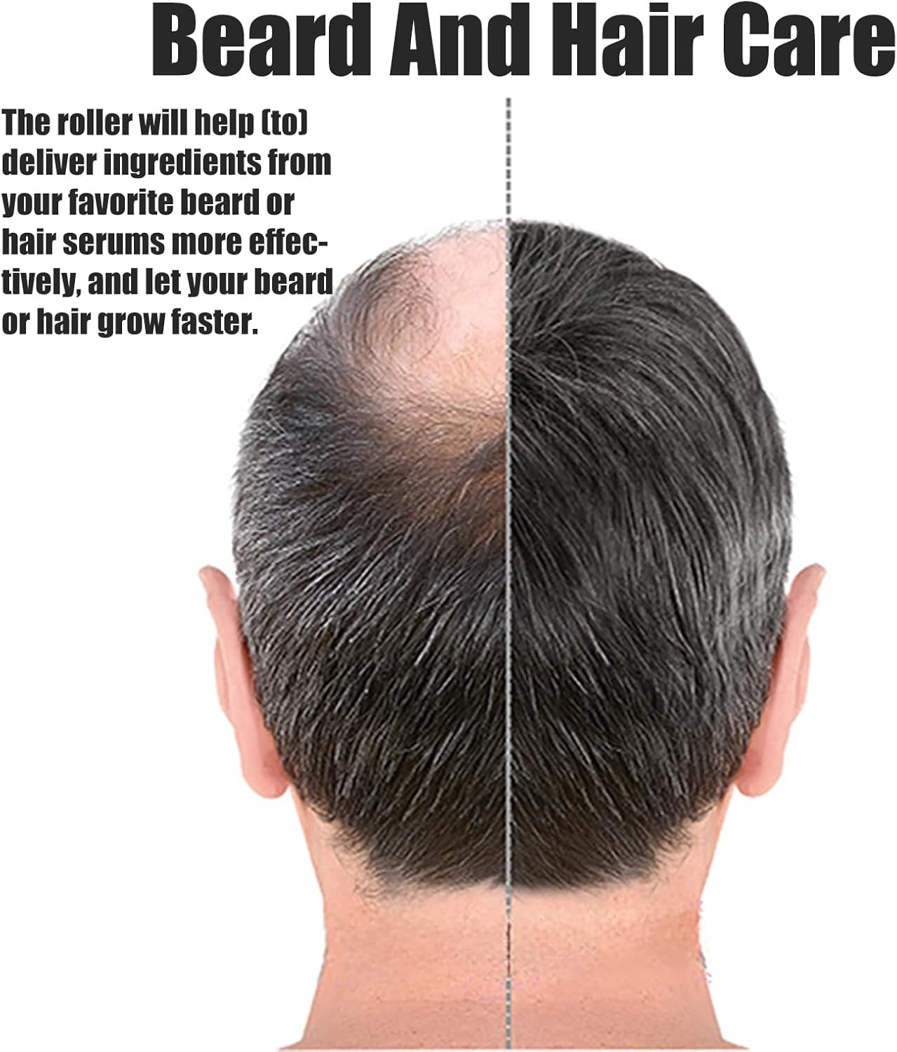 0.5Mm Titanium Derma Roller 540 Needles - Professional Microneedling Tool for Face & Hair Growth, Cosmetic Grade Dermaroller with Storage Case, Anti-Aging Skin Care Treatment Device image number 3