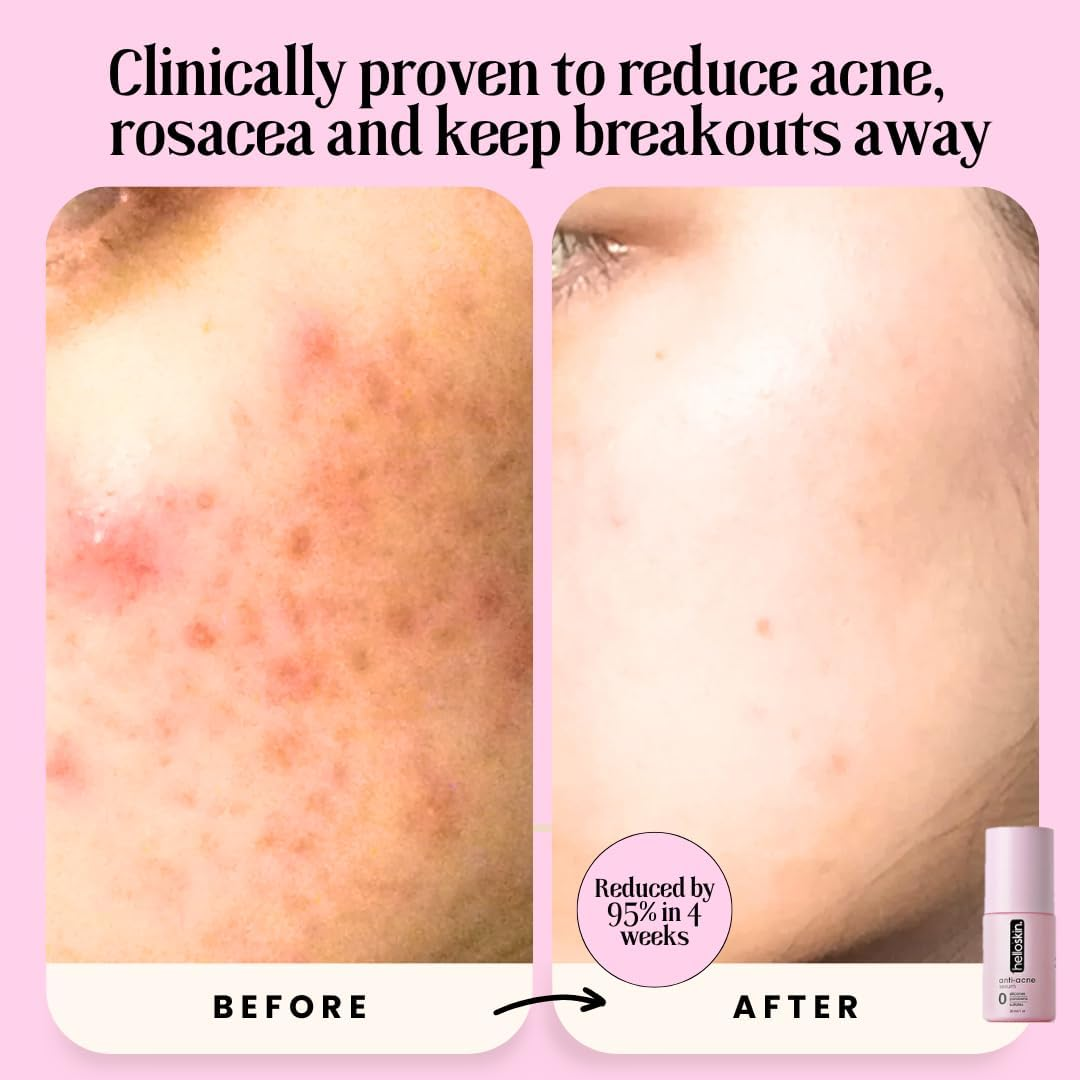 Azelaic Acid 20% & Niacinamide 10% | Helloskin anti Acne Serum (30Ml) | Face Serum for Acne Marks and Rosacea Clears Rosacea | Kills Acne | Men and Women Daily Serum for Clear Smooth, Radiant, Glowing Skin image number 3