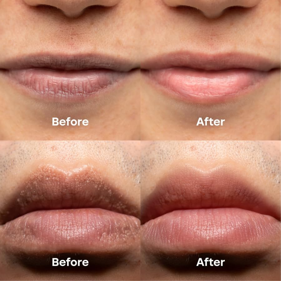 Abera Smooth Lips System: ABERA Dark Lip Corrector Cream & ABERA Fordyce Cream, a Complete Care System for Dark Lips and Fordyce Spots. Clear, Smooth, and Naturally Pink Lips Everyday