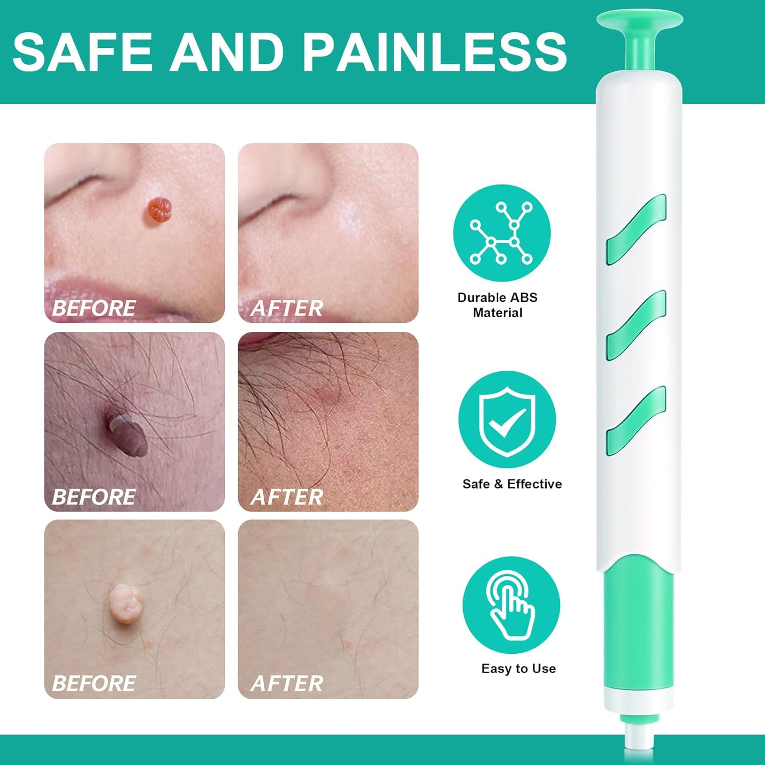 Skin Tag Remover Pen, 2-In-1 Standard Wart Remover, Skin Tag Removal, with 36 Repair Patches and Wet Wipes, Small Rubber Ring Suitable for Skin Tags Ranging from 1 Mm to 4 Mm in Size image number 3