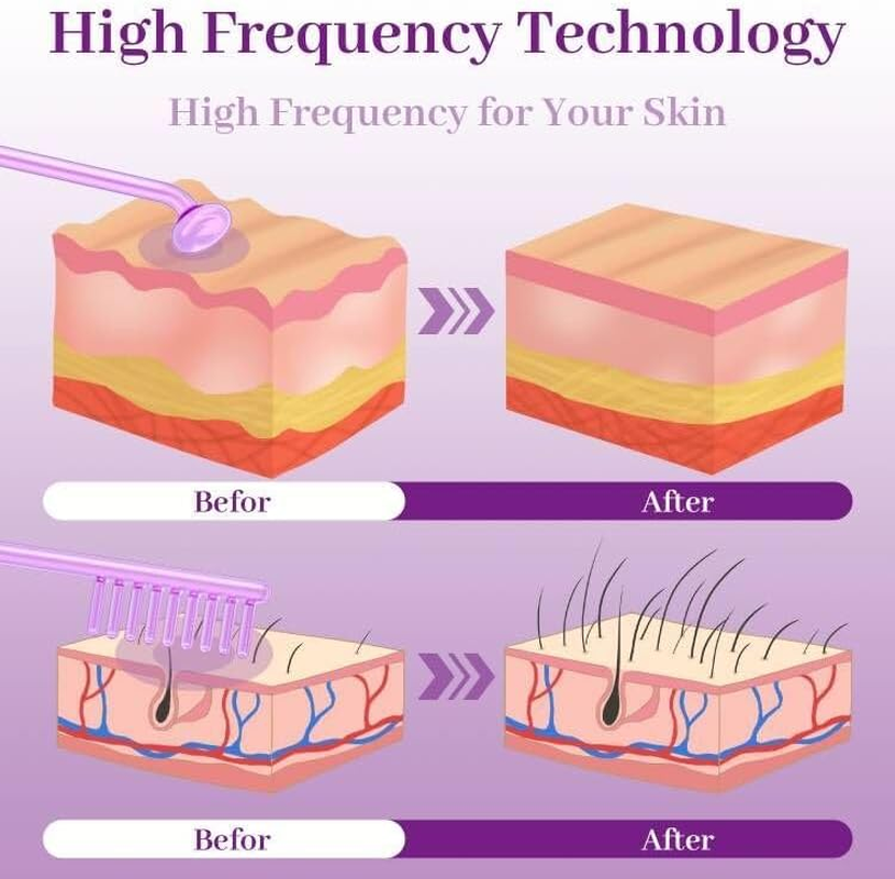 High Frequency Facial Wand - TUMAKOU Violet Portable Handheld High Frequency Facial Skin Machine Device for Face - with 4 Purple Tubes