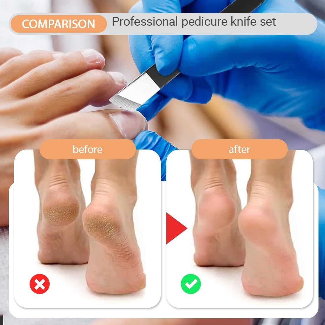 JEYORZY 5 Piece Pedicure Set Foot Care, Stainless Steel Pedicure Knife Kits with Storage Box, Stainless Steel Removal Kit, Manicure Nail File Pedicure Foot Care Tools for Hand Feet image number 4