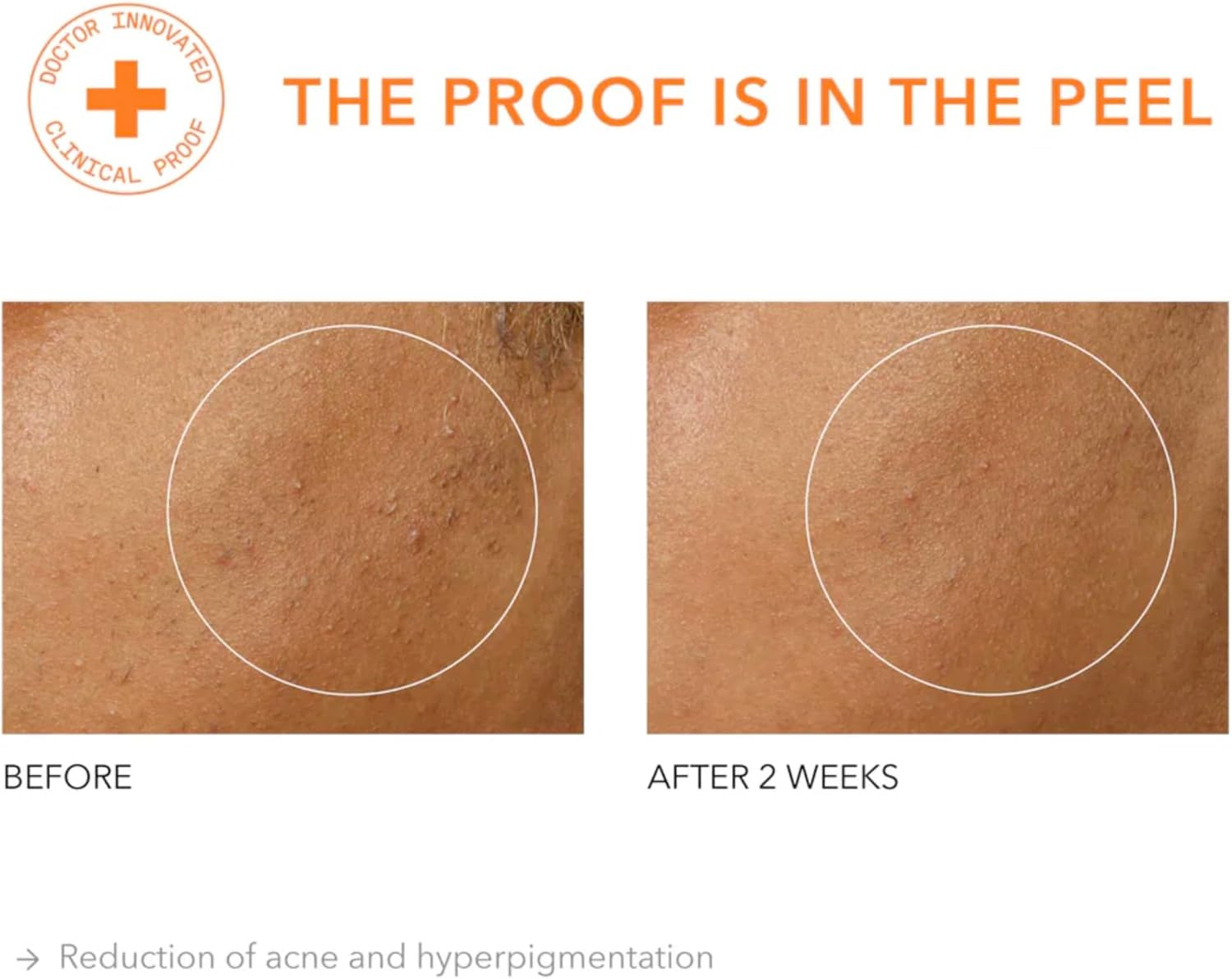 Dr Dennis Gross Alpha Beta Universal Daily Peel 5 Treatments image number 1