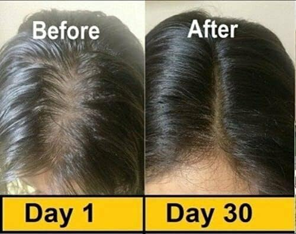 Evion 400 MG Vitamin E Capsule for Face, Hair, Pimple, Glowing Skin, Dark Circles, Skin Whitening & Control Hair Loss, 100 Capsules image number 3