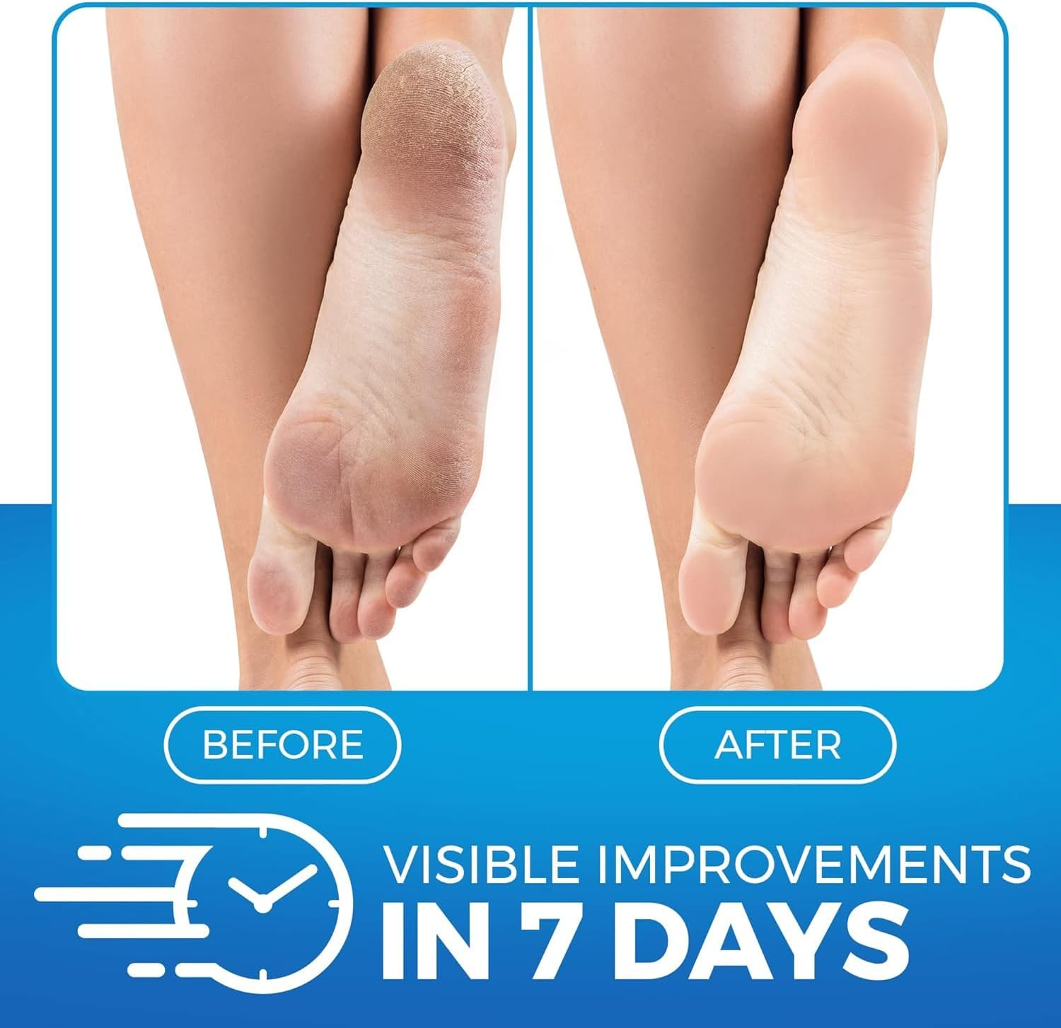 Imperial Feet Urea Foot Balm - Natural Urea Cream for Foot Care, Cracked Heel Repair, Rough Skin, Dryness, Calluses - Cleansing, Exfoliant - Wild Herb Extract - 150 Ml