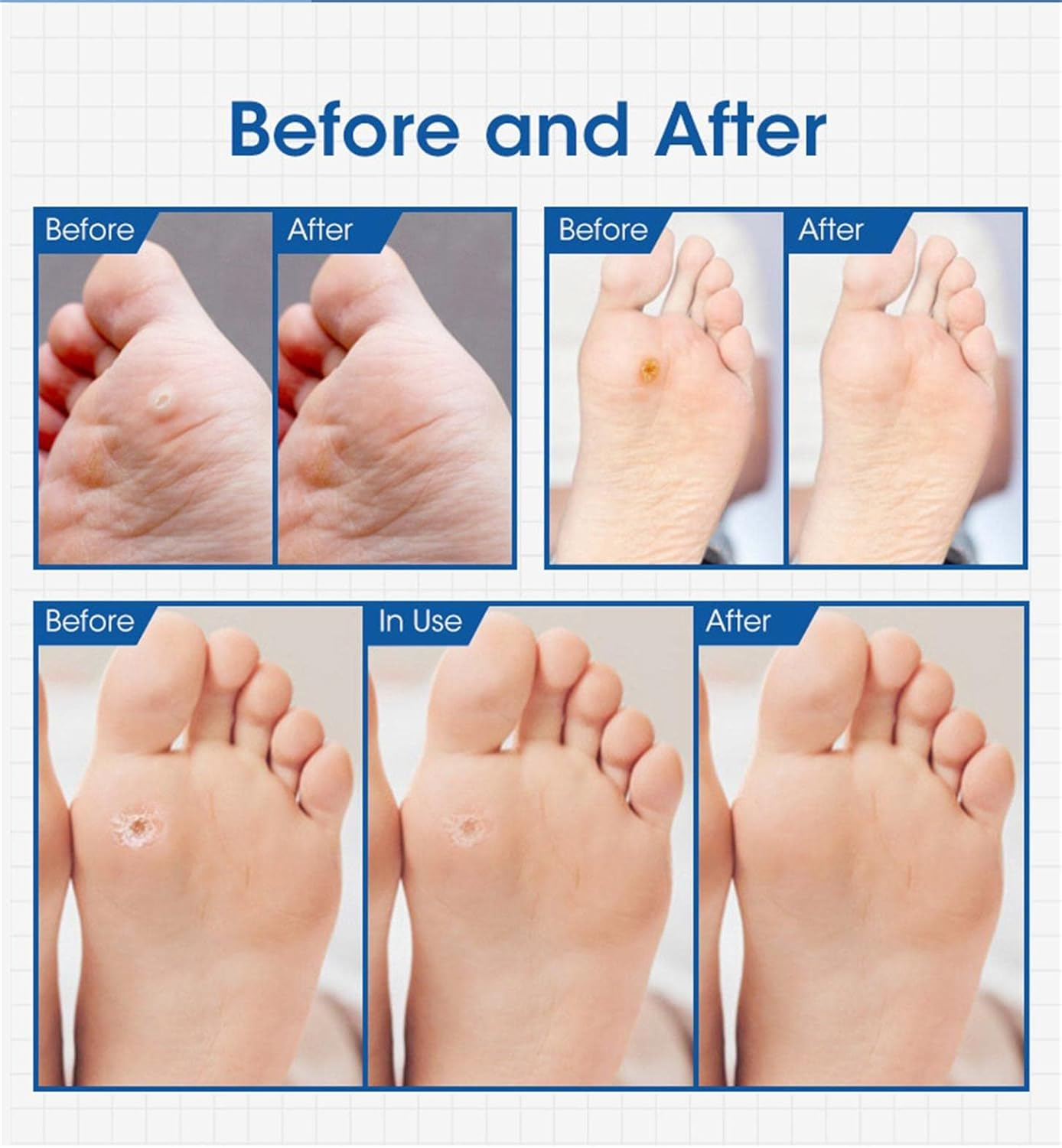 Callus Pads | Corn Removers for Toe | Adhesive Corn Protectors, Relief from Calluses, Corns, Blisters, Heel Frictions Wynott image number 4