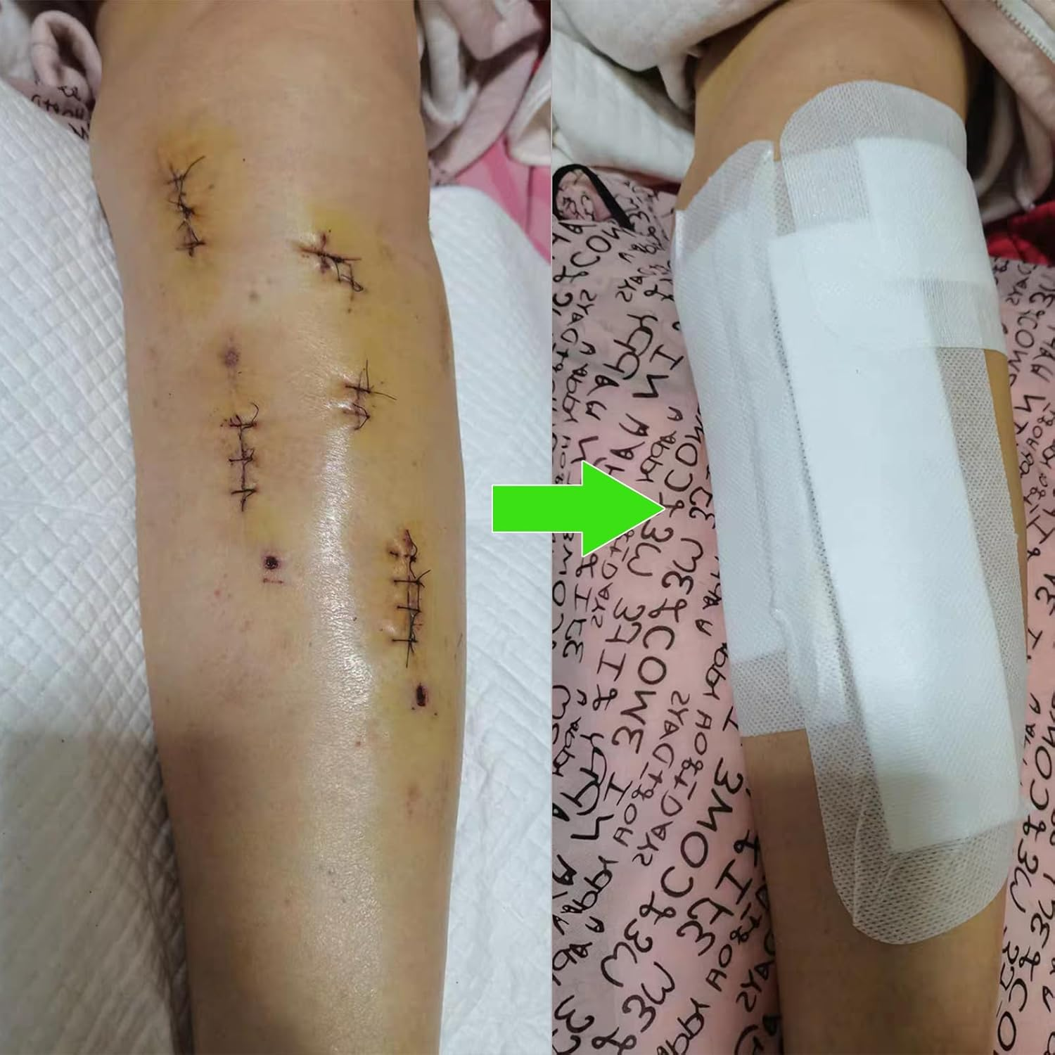 Wound Dressings Large Adhesive, Wounds Dressing Pad Bandage,Individually Wrapped(10Cmx25Cm) image number 6