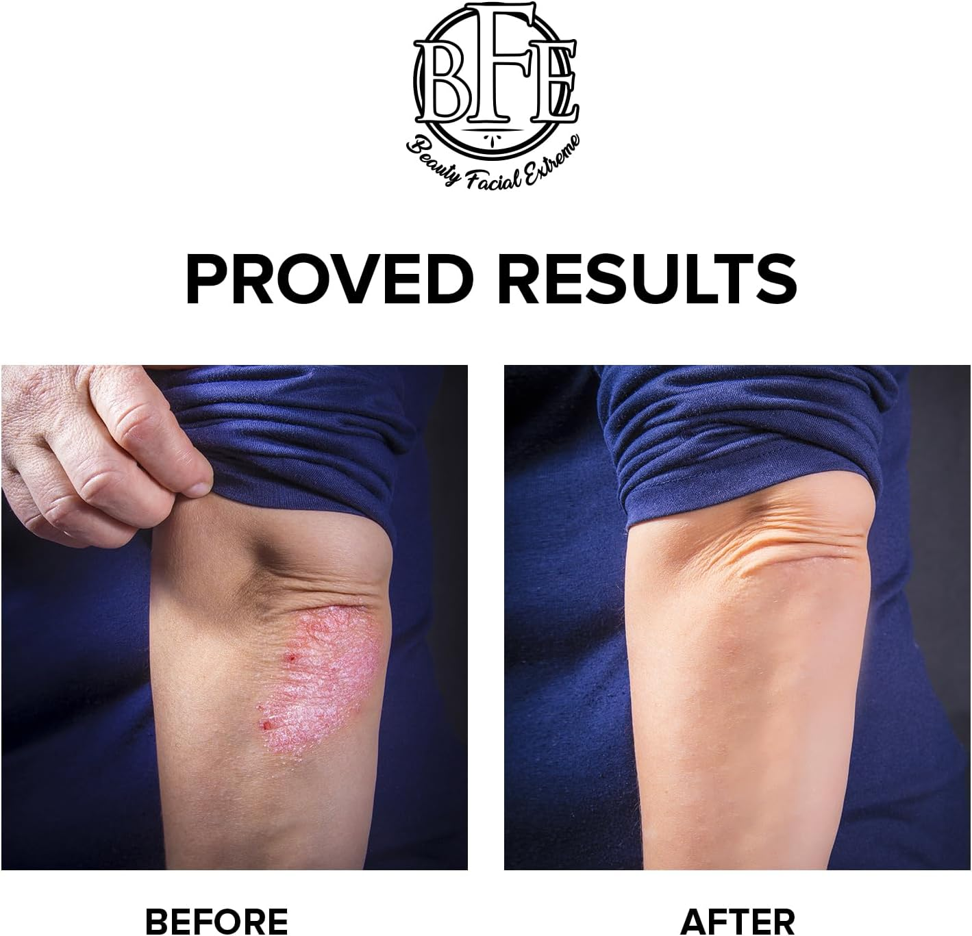 Exfoliating Body Lotion &ndash; 12% Lactic Acid Body Lotion. Provides Immediate Moisture & Gentle Exfoliation to Treat Symptoms Associated with Keratosis Pilaris & Dry Skin Conditions. image number 5