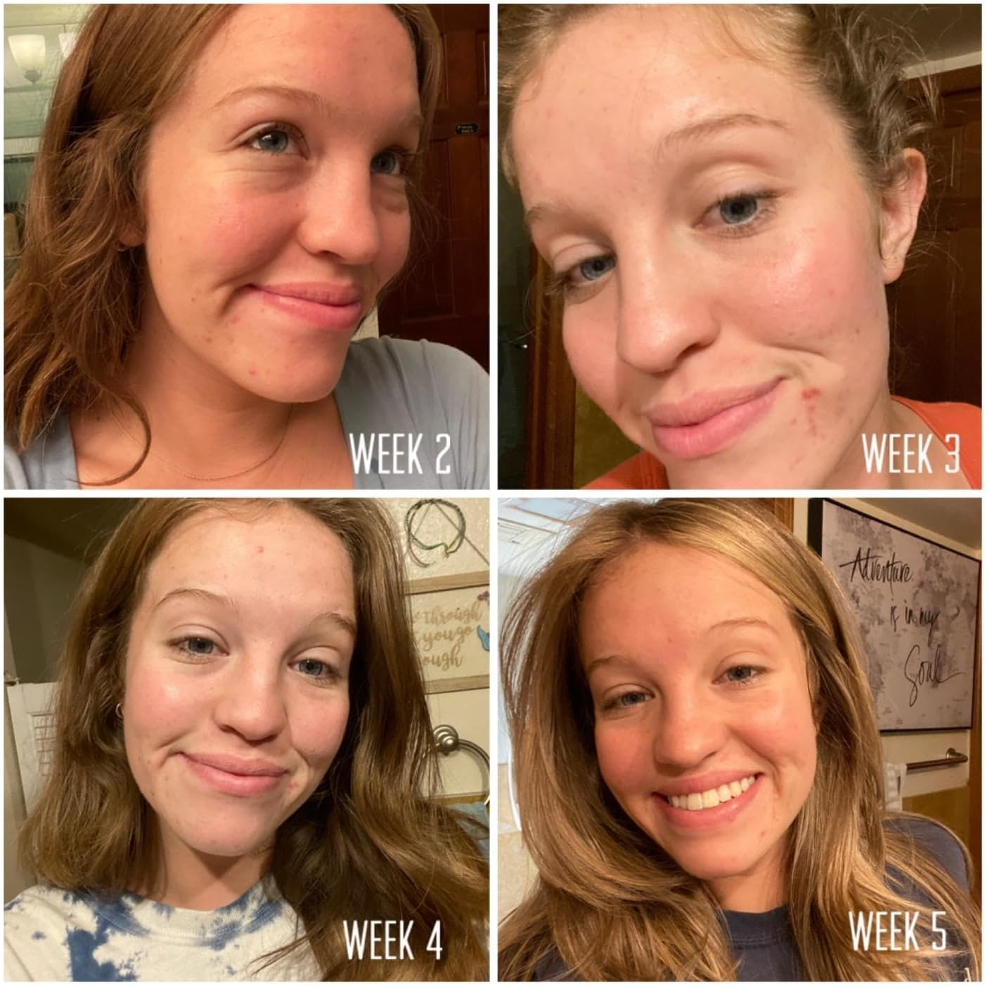 Glycolic Gel Peel 40% (Professional Skin Peel) - Enhanced with Retinol and Green Tea Extract 1FL.OZ/30ML image number 5