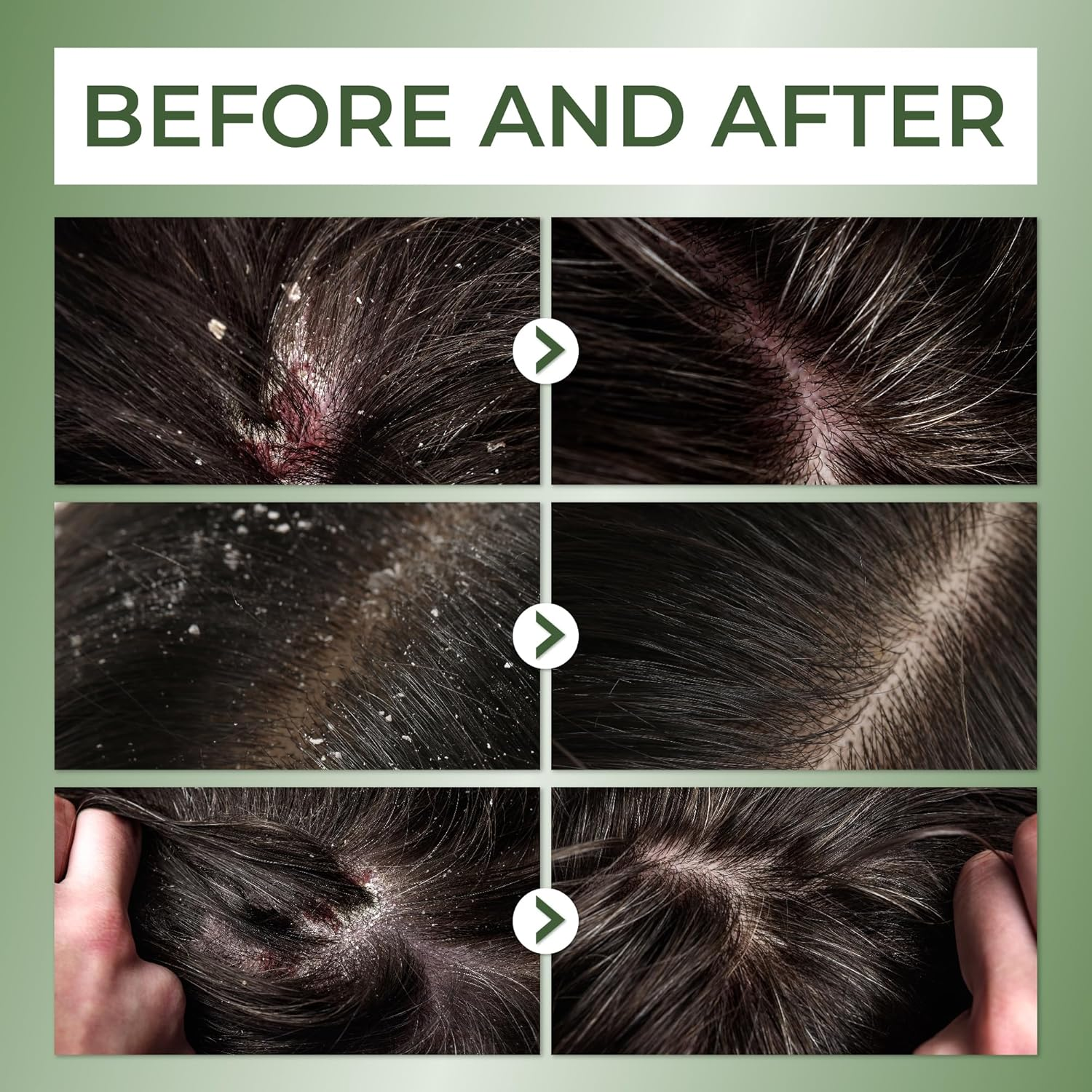 ABERA High-Performance Anti-Dandruff Shampoo &ndash; Herbal Formula with Langbian Ginseng, Natural Deep Cleansing, Sulfate & Paraben Free, Soothes Itchy Scalp &ndash; 150Ml - A. 1 Box image number 6