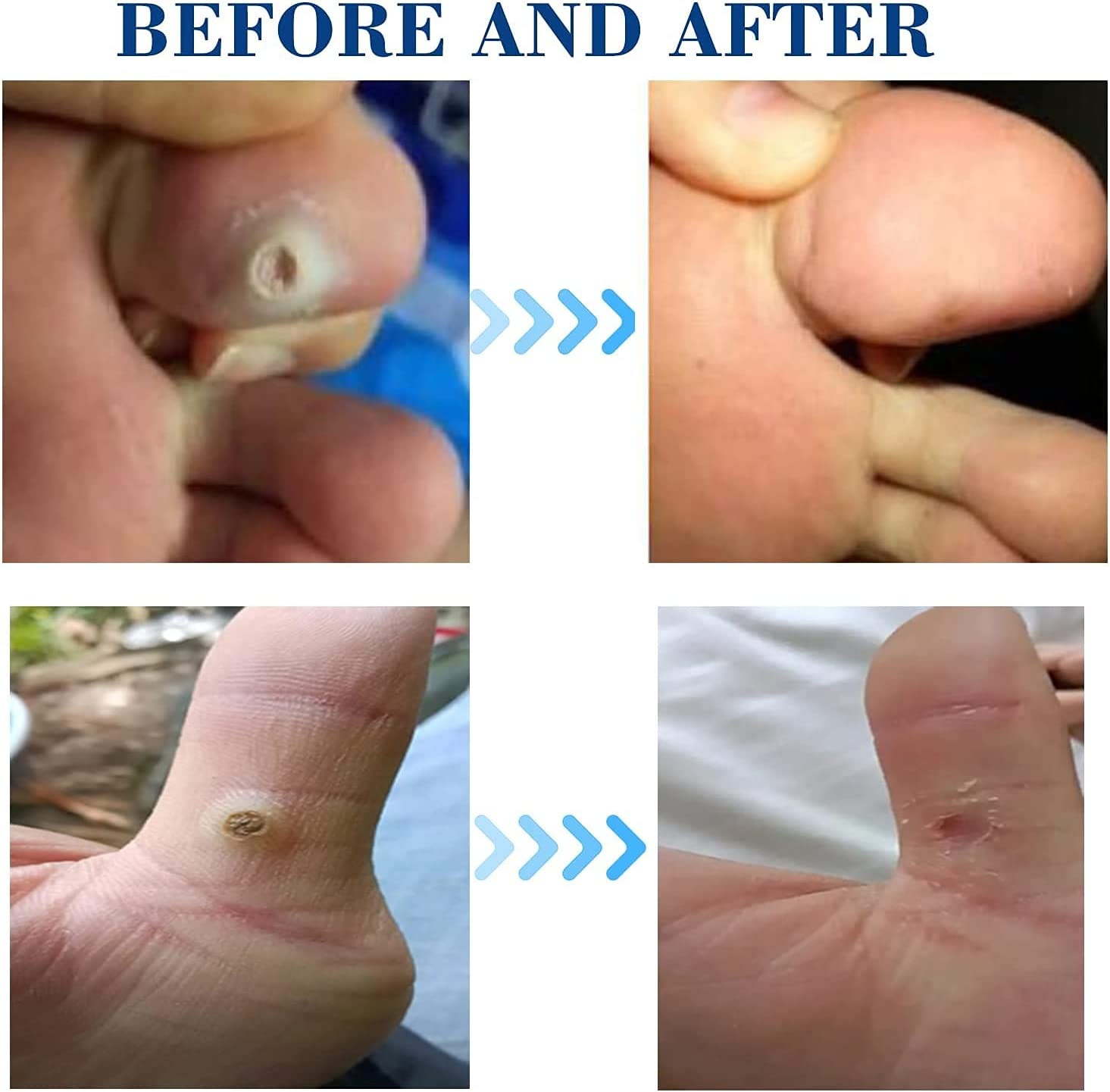 MQ Corn Remover Pads, Wart Remover, Foot Corn Remover Patch, 24 Pcs Corn Removal Pads, Corn Removal Treatment Relieve Corn Pain and Foot Care, Corn Plasters with Hole for Feet, Hand, Toe image number 2