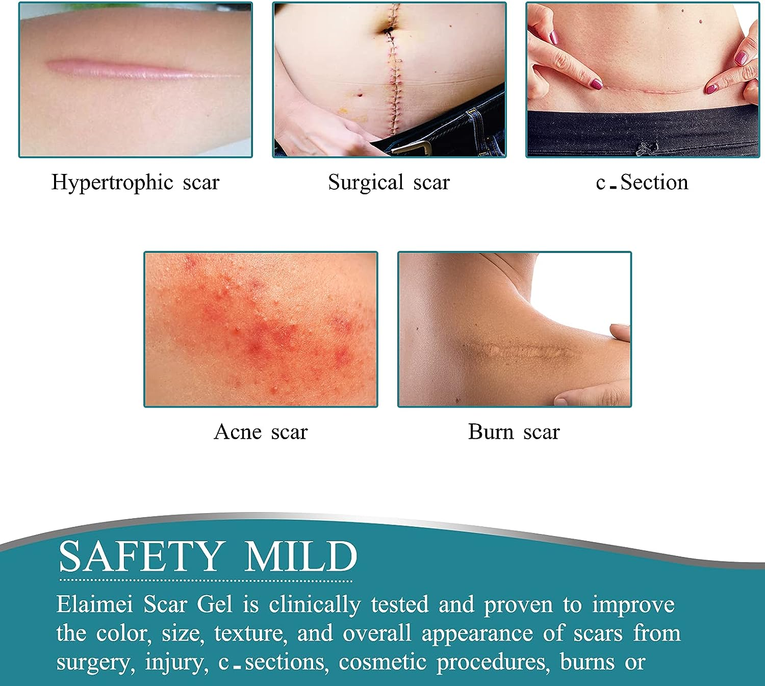 Silicone Scar Sheets, Professional Silicone Scar Sheets,Scar Silicone Tape Strips, Scar Removal Sheets for C-Section,Scar Removal Sheet Long Strips for Acne Burn, Keloid (1.6&rdquo; X 60&rdquo;) image number 1