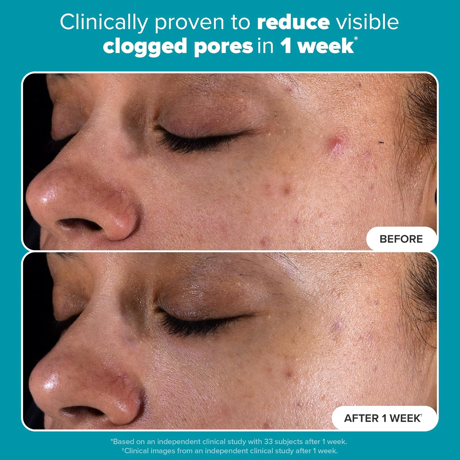 Paula'S Choice Skin Perfecting 2% BHA Liquid Salicylic Acid Exfoliant, Gentle Facial Exfoliator for Blackheads, Large Pores, Wrinkles & Fine Lines, Travel Size, 30 Ml Bottle image number 4