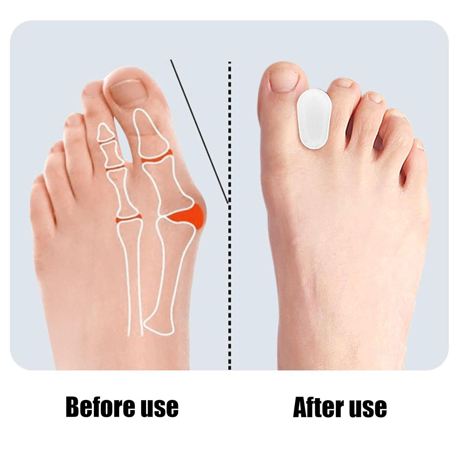 Xolixorium 10 Pack Toe Spacers Separators - Premium Gel Toe Separators for Bunion Discomfort and Overlapping Toes Care Everyday Comfort Toe Spacers L Size image number 4