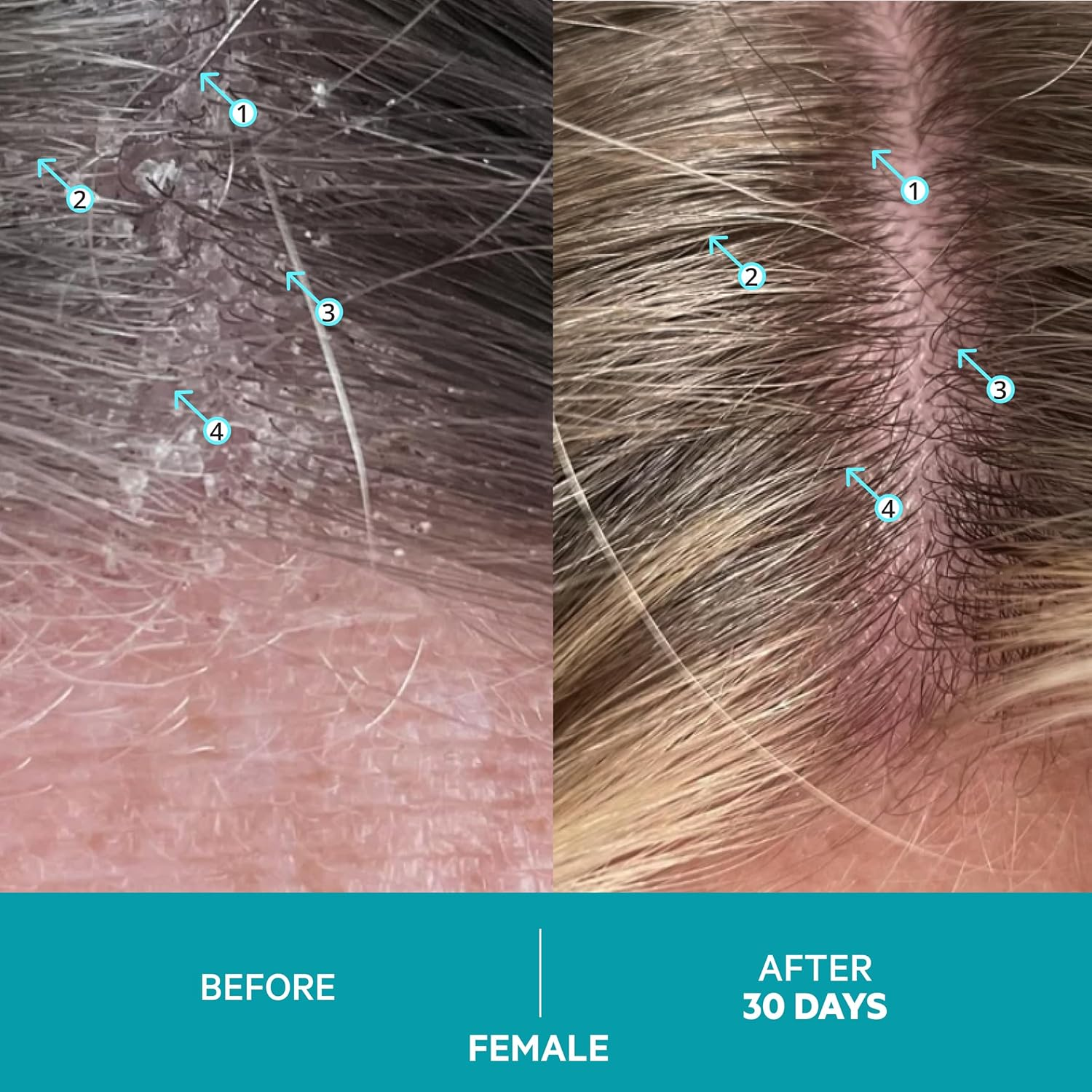 Dandrene Dandruff Shampoo by DS Laboratories &ndash; Shampoo for Itchy, Dry Scalp, Psoriasis Shampoo, Seborrheic Dermatitis Shampoo, for Men and Women (205Ml) - 2 Pack