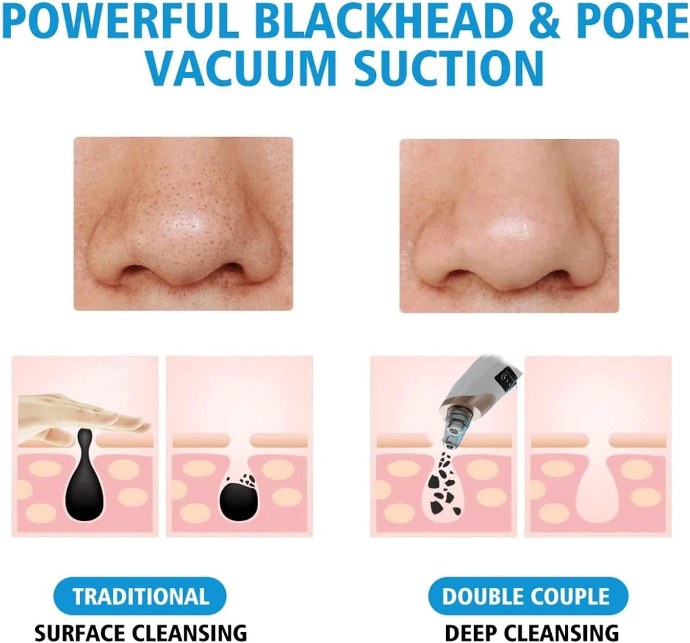 Annuoyi Blackhead Remover Vacuum, with 5 Detachable Facial Cleaning Suction Heads, USB Rechargeable Acne Removal Vacuum Kit, Suitable for Female and Male Facial Skin(White) image number 6