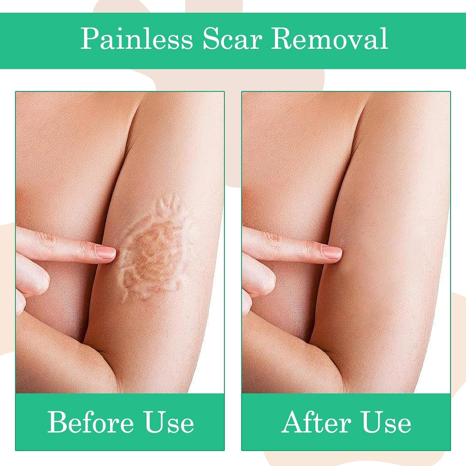 Silicone Scar Tape, 2 Pcs Silicone Scar Sheets, Soft Silicone Tape, Hydrocolloid Bandages for C-Section, Surgery, Burn, Keloid, Acne Et, Easy Tear Reusable Scar Removal Sheet (1.6 &times; 60 Inch) image number 3