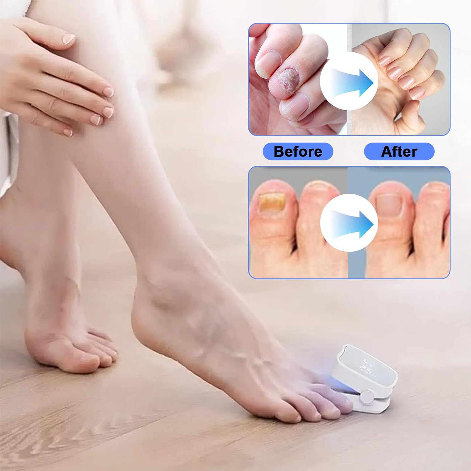 Upgrade Nail Fungus Laser Device, Nail Fungus Treatment Quick Intense for Multiple Toenails & Fingernails, 470Nm Blue Light Painless Laser Nail Fungus Treatment for Toenail, Restore Healthy Nails