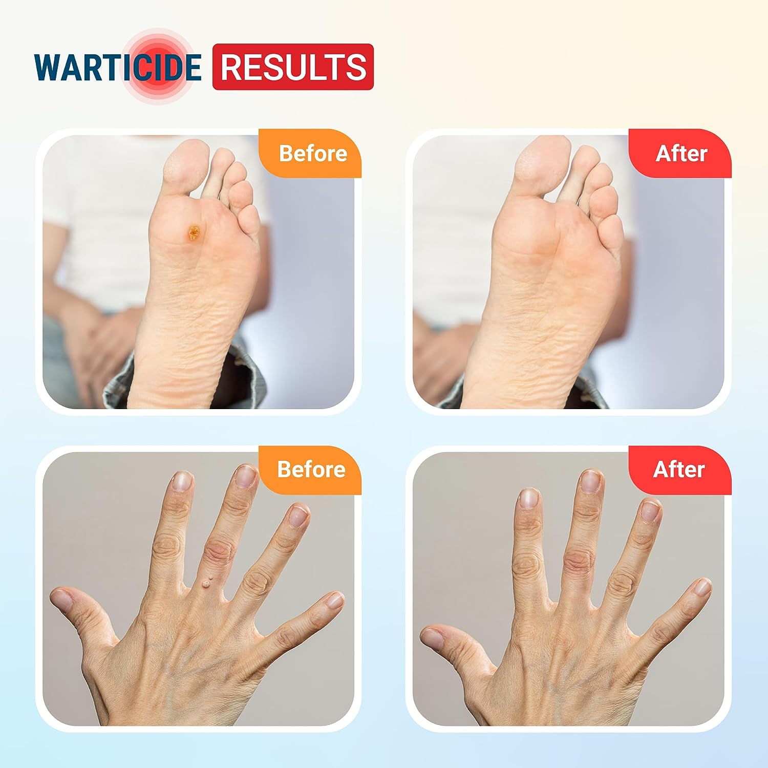 Fast-Acting Wart Remover - Plantar and Genital Warts Treatment, Attacks Warts on Contact, Easy Application (1 Bottle) image number 5