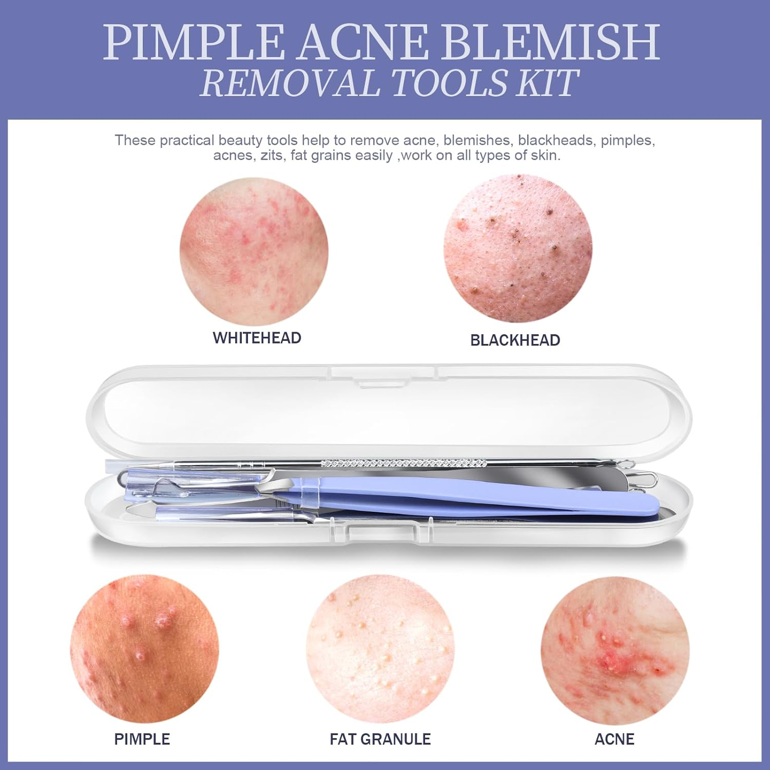 Teenitor Pimple Popper Tool Kit, 6 Pcs Blackhead Remover Tools, 1 Ingrown Hair Tweezers, Pimple Extractor Pore Extractor Acne Tools Blackhead Extractor, Black Head Remover for Face Nose - Light Green image number 5