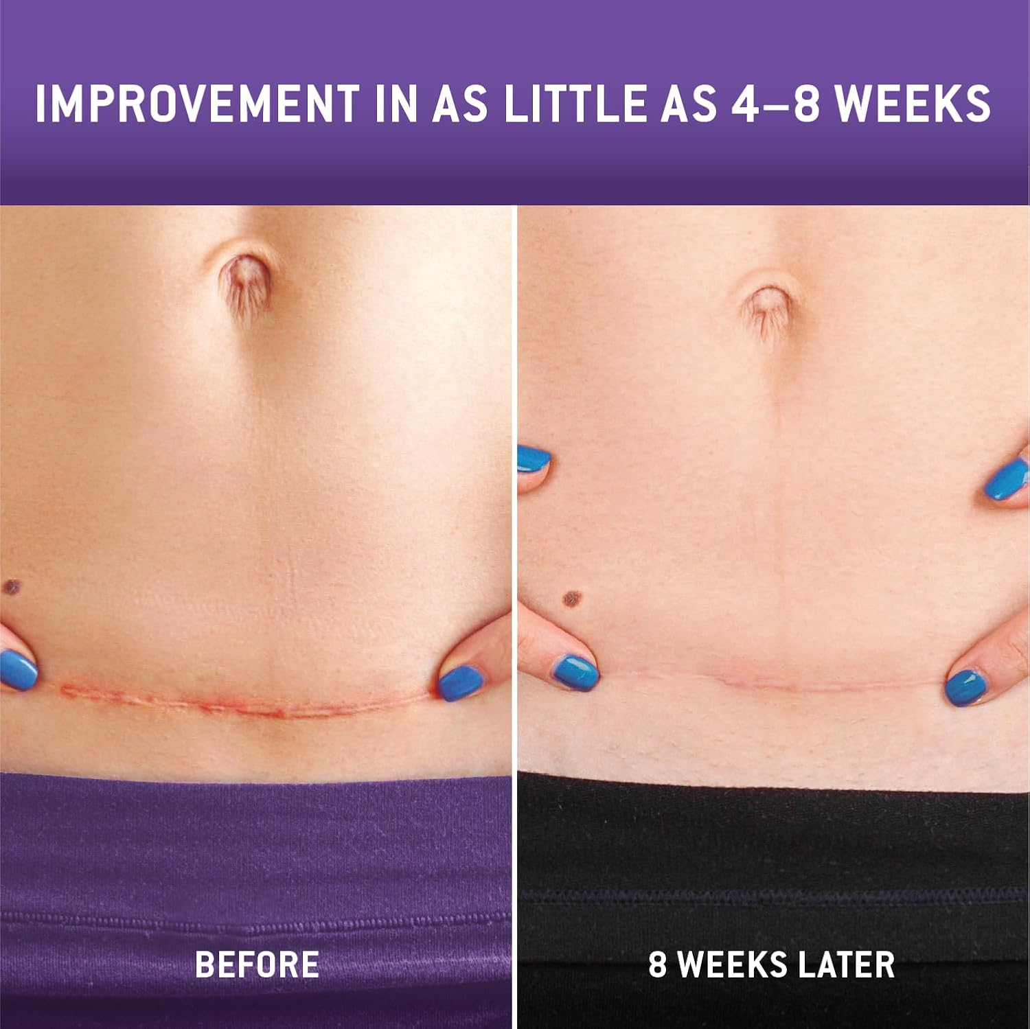 Care Science C Section Recovery Silicone Scar Sheets 1.5In X 7In 8Ct | Reuseable Scar Sheets for Reducing the Appearance of C-Section, Keloid, and Acne Scars