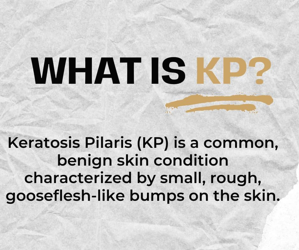 Areton Bump Eraser Body Bump Eraser Exfoliant for Keratosis Pilaris Cream with 5 Active Ingredients Kojic Acid, Lactic Acid, Glycolic Acid, Niacinamide & Salicylic Acid | Rough Skin