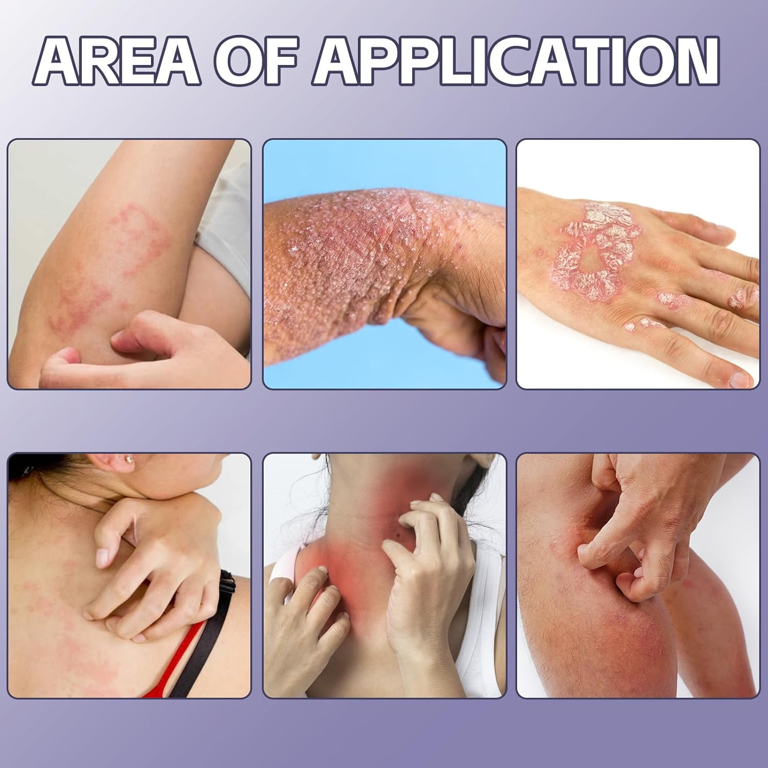 Psoriasis Creams Dermatitis Cream,Eczema,Soothes Red & Inflamed Skin,Moisturizing Body Cream,Lotion