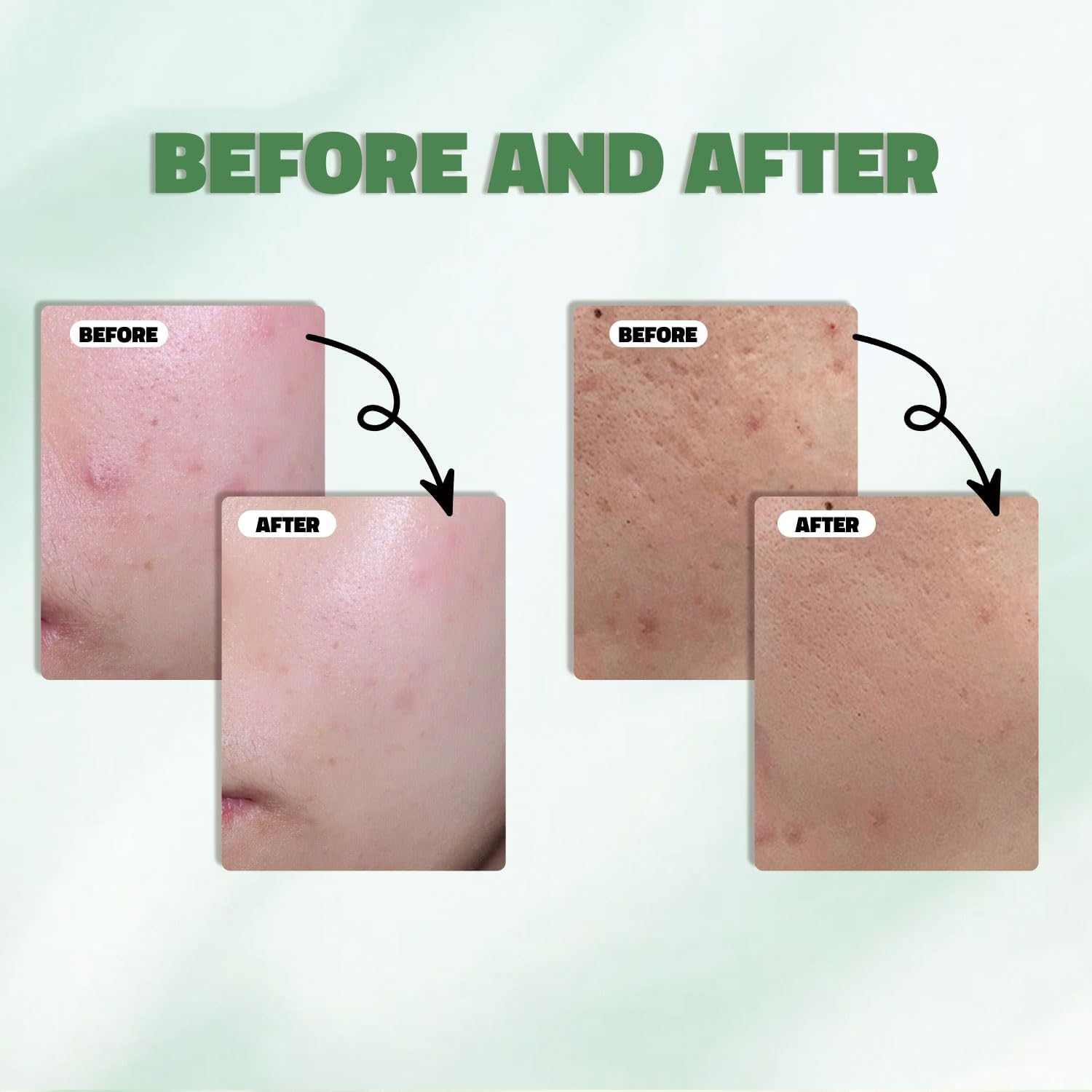 10% Azelaic Acid + Hyaluronic Acid Calming Serum - a Gentle Facial Serum for Sensitive Skin, Formulated with Hyaluronic Acid to Help Soothe Skin, Vegan-Friendly, 30Ml【Not Aunaxxx Brand】 image number 6