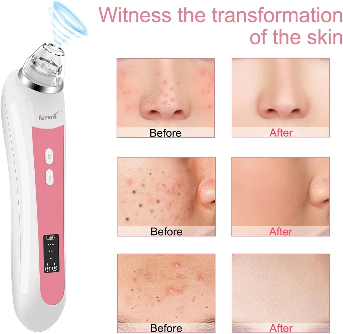 Blackhead Vacuum, Asperx 5.0 Megapixels Visible Blackhead Remover Facial Pore Vacuum, 20X Microscope Blackhead Suction Tool, Rechargeable Suction Facial Pore Cleaner with 6 Replaceable Tips(Upgraded) image number 1