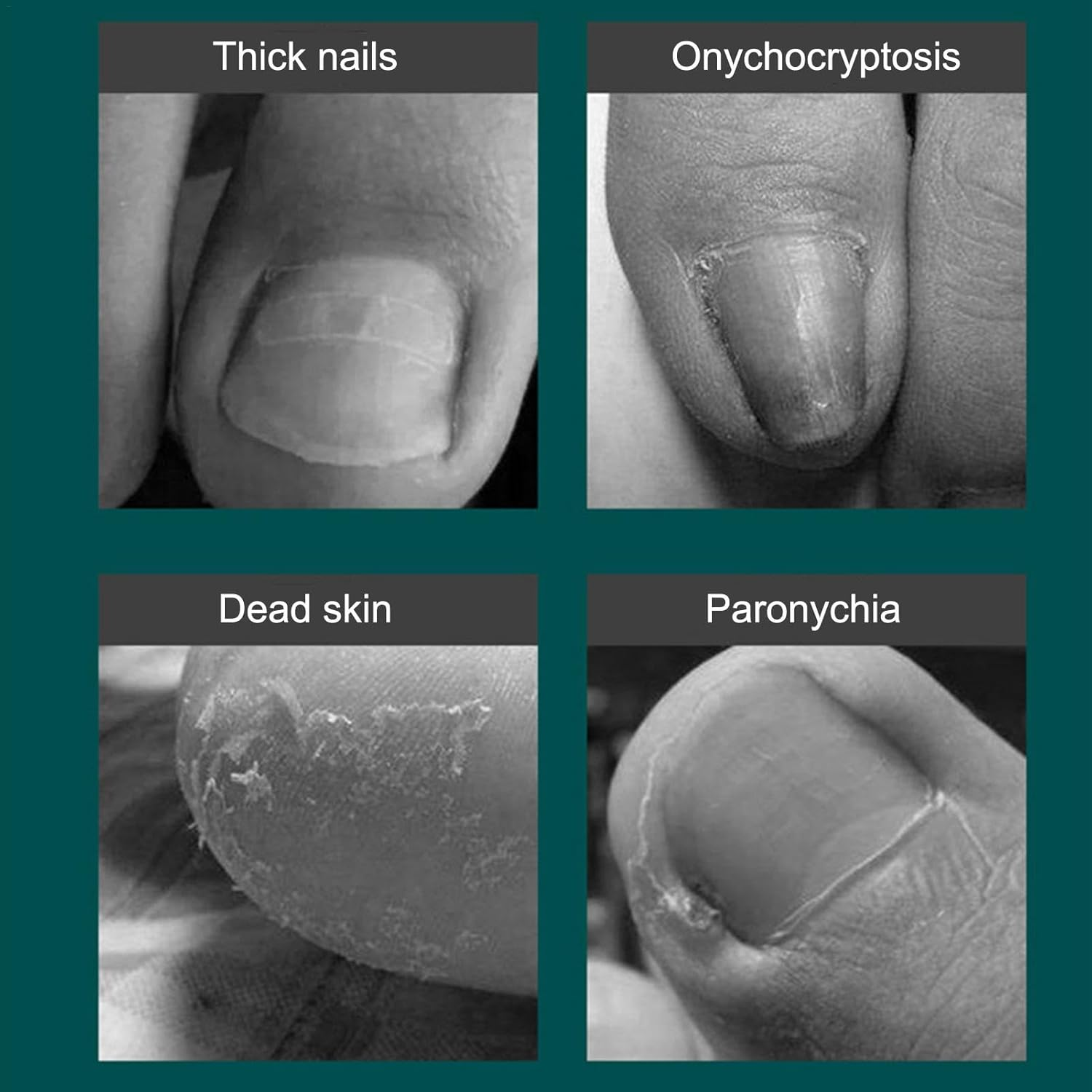 Thick Nail Cutters | Toenails Trimmer | Stainless Steel Pedicure Tools with Non-Slip Rubber Handle, Professional Thick & Ingrown Toe Nail Cutters for Men, Women and Seniors image number 5