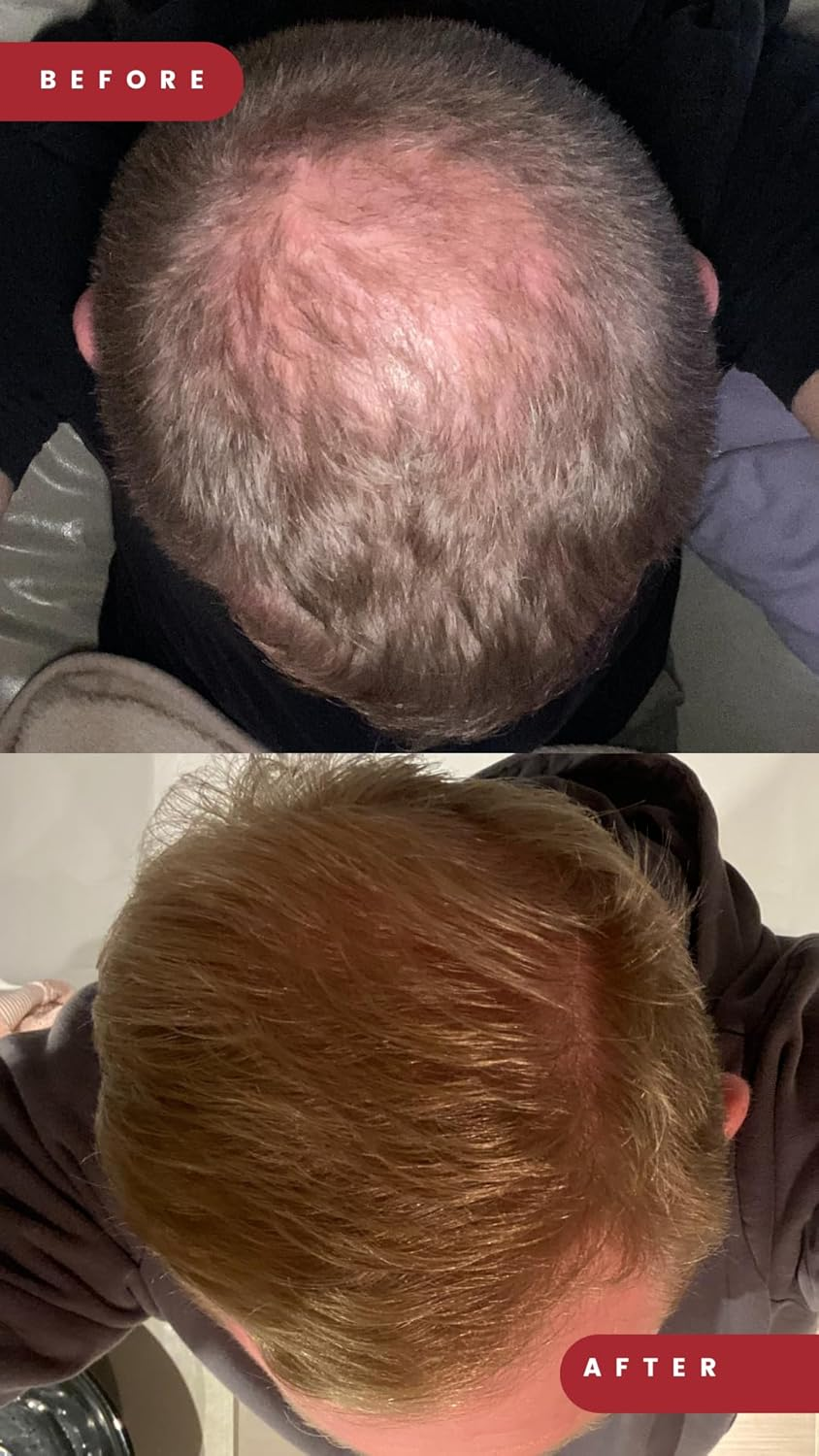 Grow Laser Cap Proflex 302 Medical Grade Laser Diodes for Hair Regrowth Men and Women, FDA Cleared, At-Home Hair Loss Regrowth Device, Low Level Laser Therapy (LLLT) image number 6