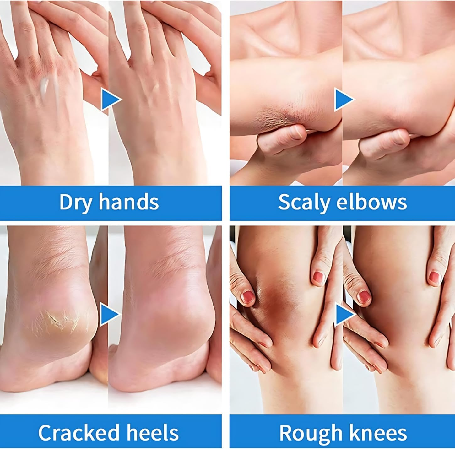 Urea Cream 40% Moisturizer for Feet and Cracked Heels and 2% Salicylic Acid Strength Foot & Hand Cream Removes Dry Skin & Calluses with Non-Greasy Deep Hydration for All Skin Types image number 1