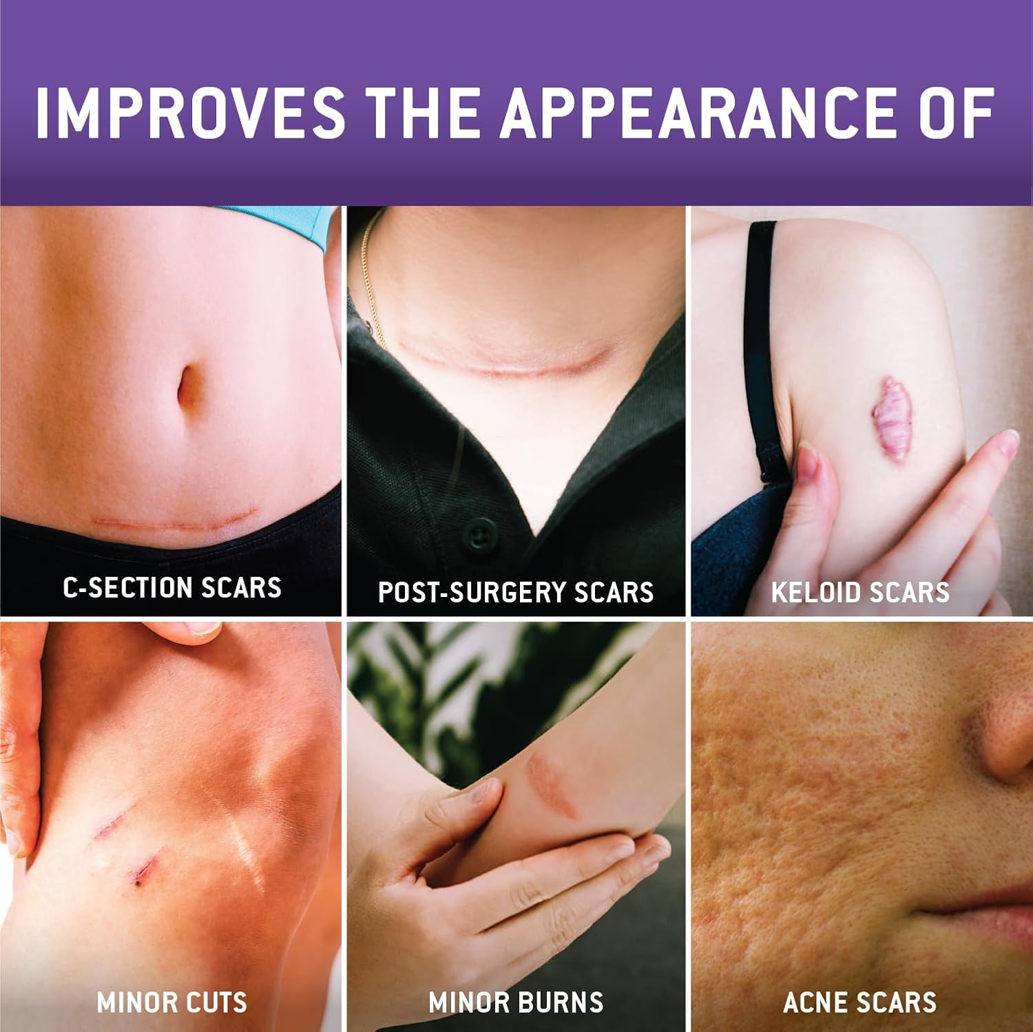 Care Science C Section Recovery Silicone Scar Sheets 1.5In X 7In 8Ct | Reuseable Scar Sheets for Reducing the Appearance of C-Section, Keloid, and Acne Scars image number 5