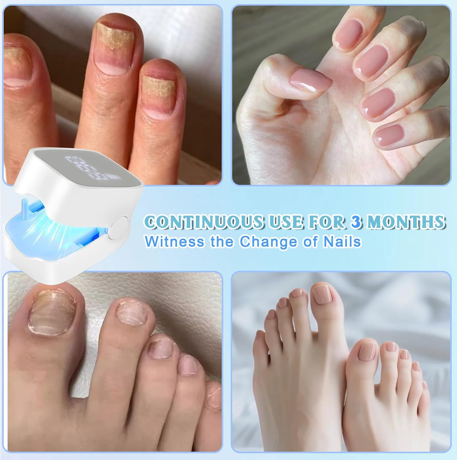 TZEKING Upgrade Nail Fungus Laser Device with Time Display, Nail Fungus Laser with Timer, Nail Fungus Treatment Device for Fingers and Toenails, Nail Fungus Treatment Quick Intensive, Nail Cleaning image number 3