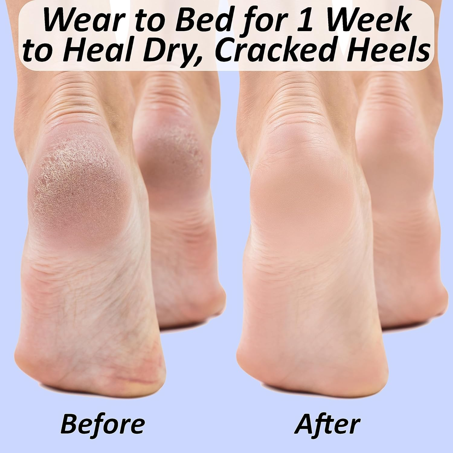 Moisturizing Socks for Cracked Heel Treatment: Socks for Cracked Heel Repair, Silicone Toeless Socks, Spa Gel Socks for Dry Cracked Feet Women, Lotion Moisture Pedicure Socks image number 1