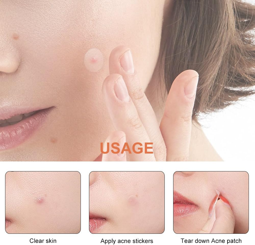 Pimple Patches for Face 150 Pack &ndash; Hydrocolloid Pimple Stickers for Blemish Care, Oil Absorbing Spot Dots for Clear Looking Skin, Gentle on Sensitive Skin (72 Patches)