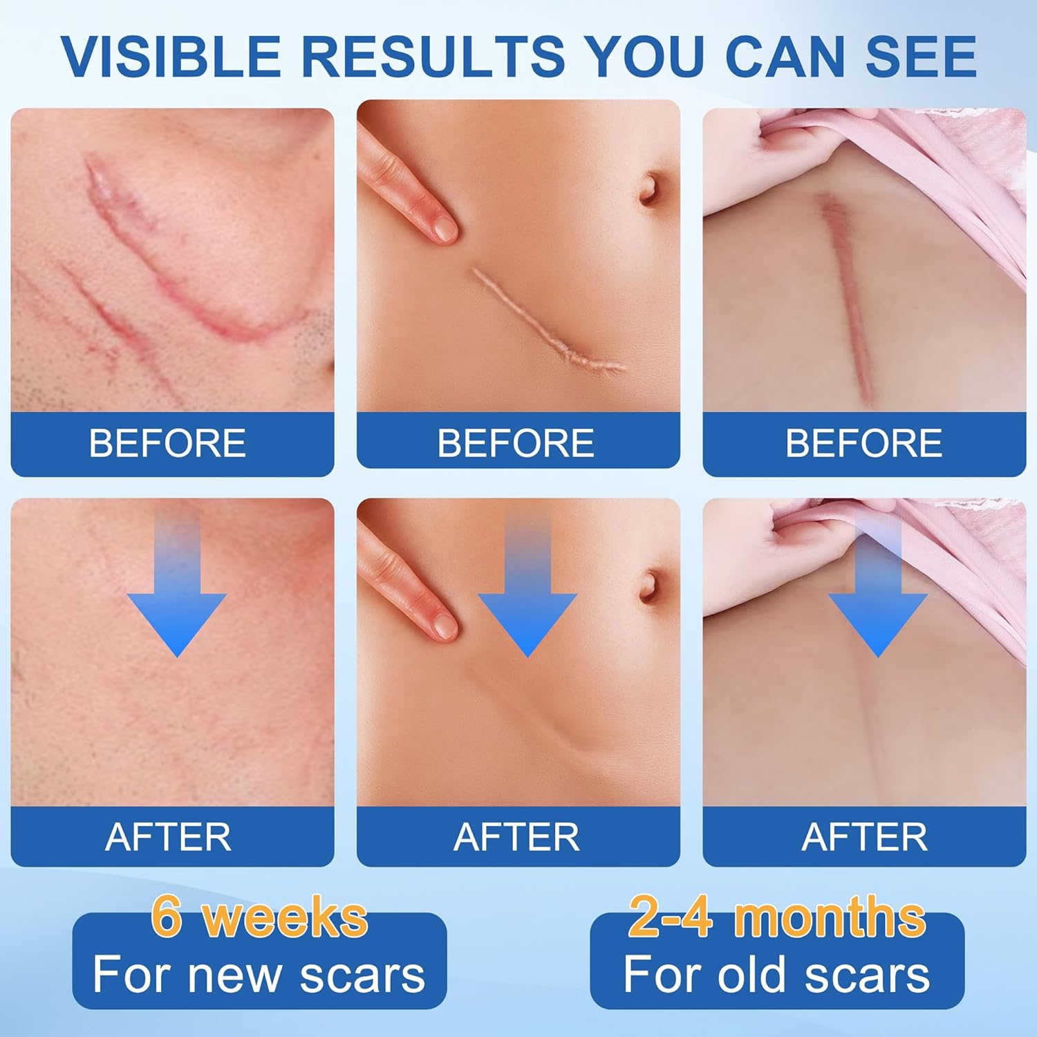 Silicone Scar Sheets - Silicone Scar Tape (1.6"X 60" Roll-150Cm) for Surgical Scars, C-Section, Keloid Scars, Hypertrophic Scars | Reusable Scar Strips image number 2