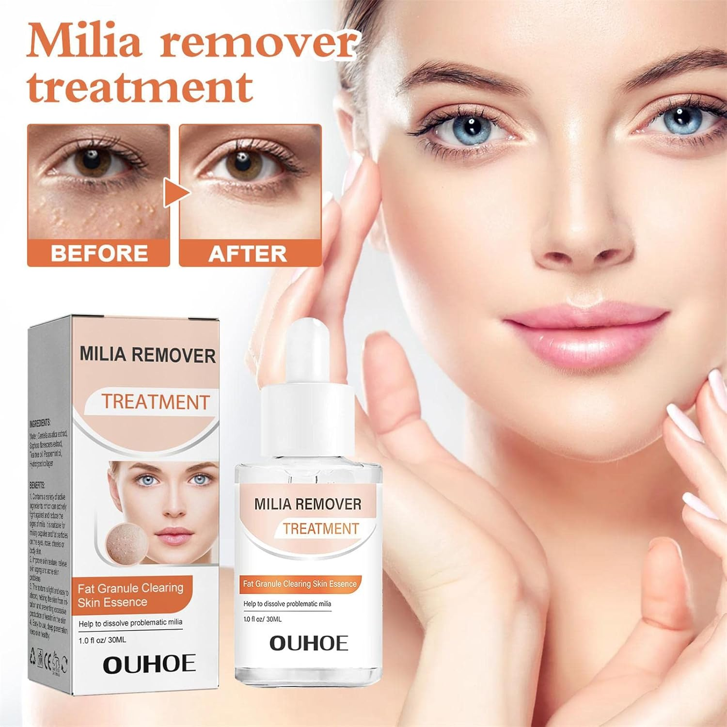 Milia Remover - 30Ml Gentle and Safe Milia Remover for Fat Granule Clearing - Milia Spot Skin Care Product Helps Dissolve and Reduce Milia, Works Face And image number 4