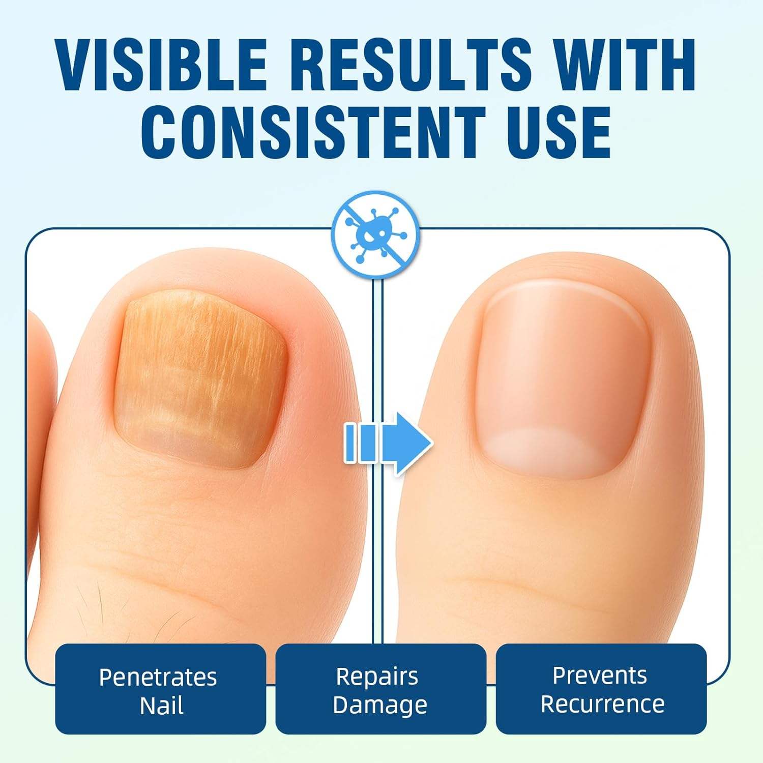 Extra Strength Toenail Fungus Treatment &ndash; Nail Repair Solution to Restore Damaged, Discolored, and Brittle Nails with Fast-Acting Natural Formula for Healthy Growth, 30Ml image number 4