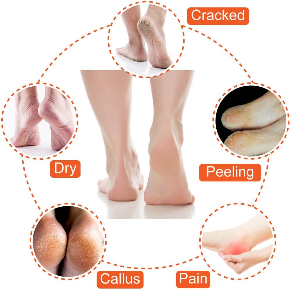 Selizo 5 Pairs Moisturizing Gel Heel Socks Open Toe Socks for Dry Hard Cracked Heels, 5 Colors