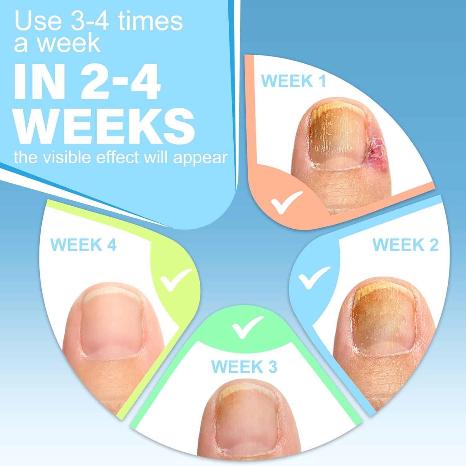 Ingrown Toenail Treatment W/Ingrown Toenail Drops Reliever & Softener,Double Sided Pedicure Nail Lifter Tool for Easy Trimming Care Thick Nail & Ingrown Toe Nail,Toenail Cleaner Kit for Men Women image number 6