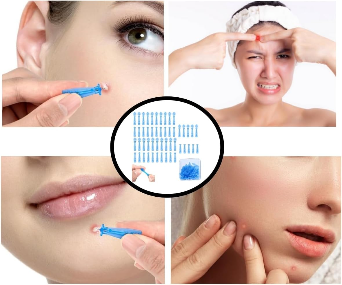 Hpessoterr 50 Pcs Acne Pimple Needles,Sterile Needles for Pimples, Suitable for Acne, Blackhead and Acne Removal, Clean Skin, Pimple Popper Set for Salon and Home Use(Blue） image number 5