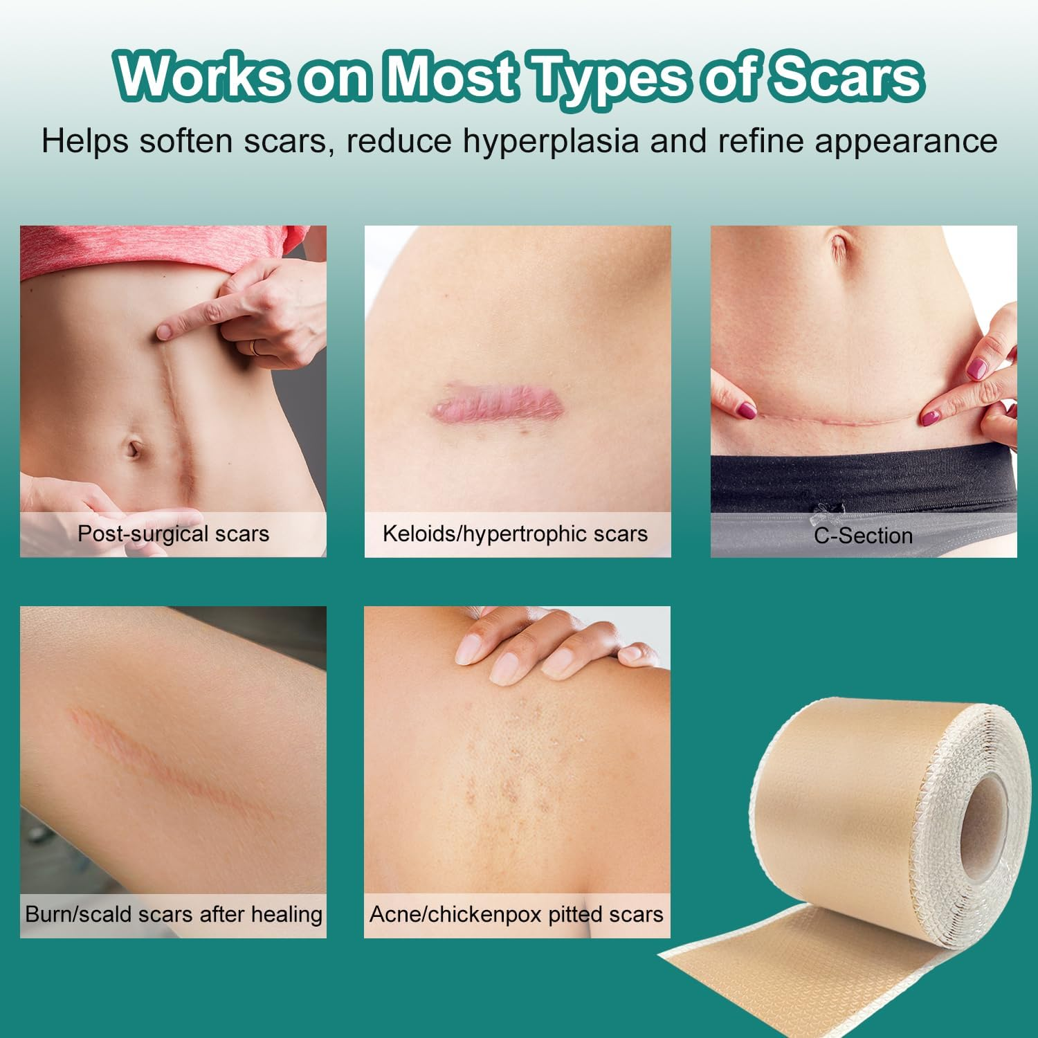 VICHYIE Silicone Scar Tape, Great Adhesion, Skin-Friendly, Reusable, Silicone Scar Sheets for Surgical/Trauma/Keloids/Acne Scars (4 X 150Cm)