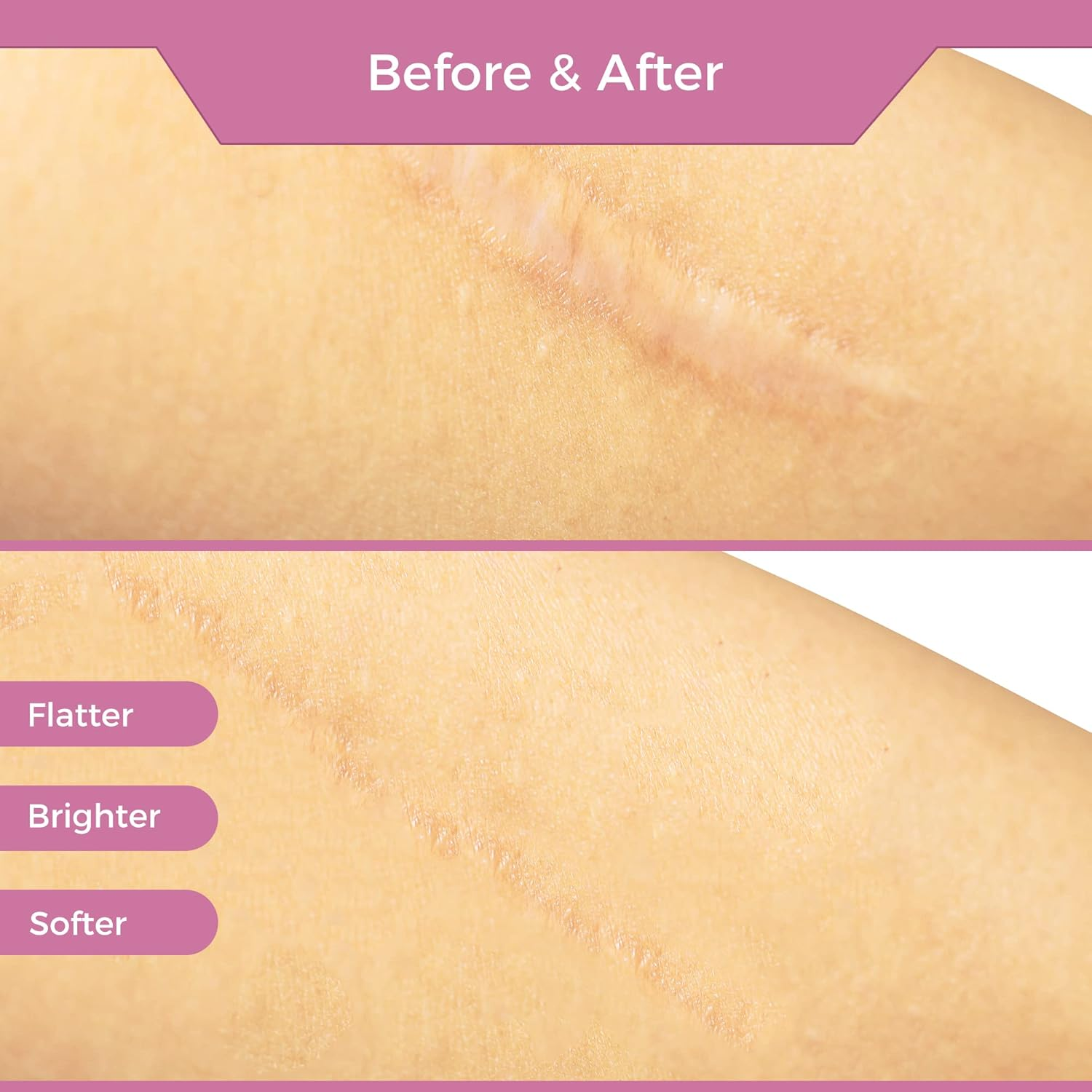 Professional Medical Silicone Scar Tape - Grade Scar Sheets, Non Irritating, Painless for C-Section, Surgical Scars, Burn, Keloid, Acne, Provide Safe and Effective Solutions(1.6&rdquo; X 60&rdquo; Roll) image number 2